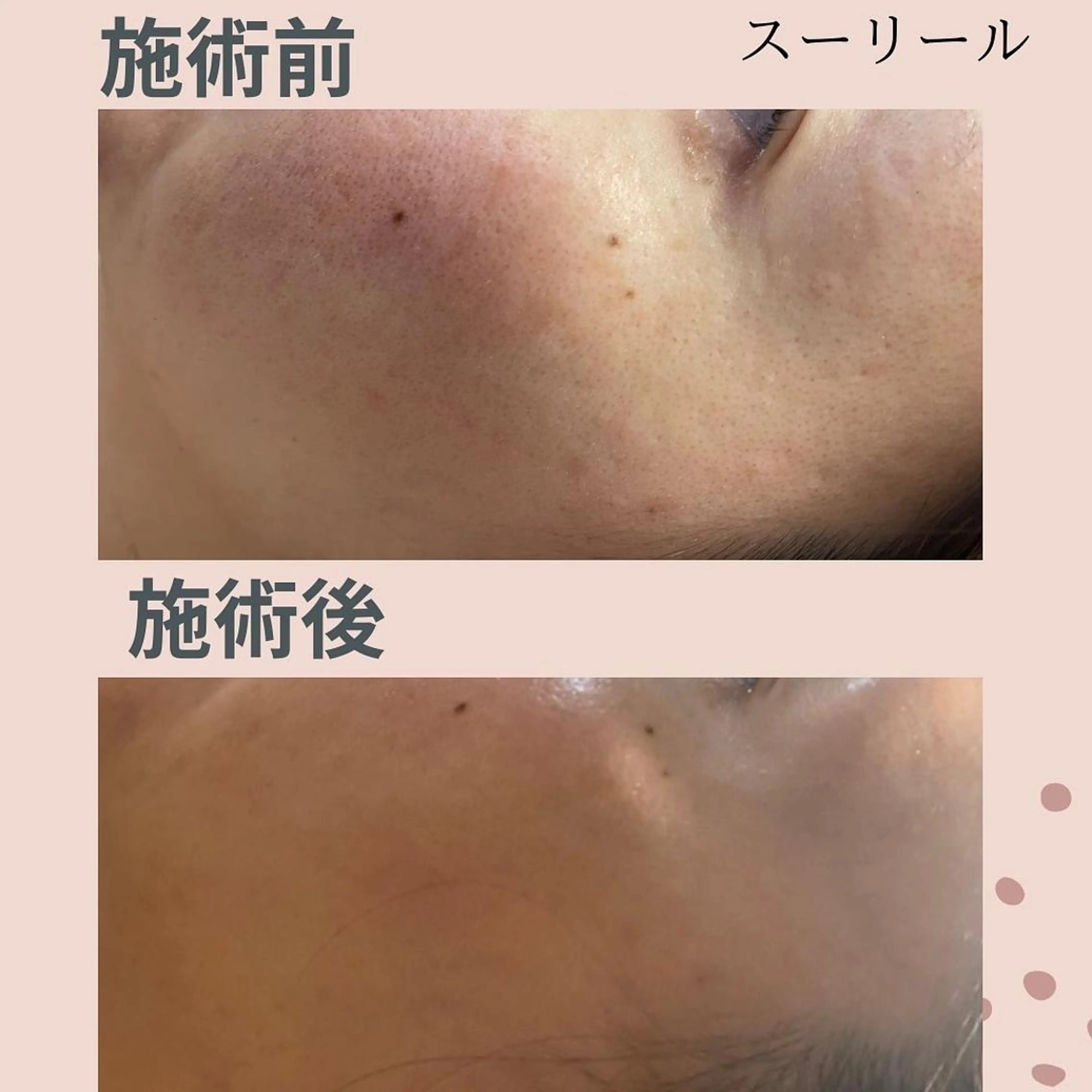 ニキビ　敏感肌の悩みの方　有機玄米の酵素パックで肌質改善の写真