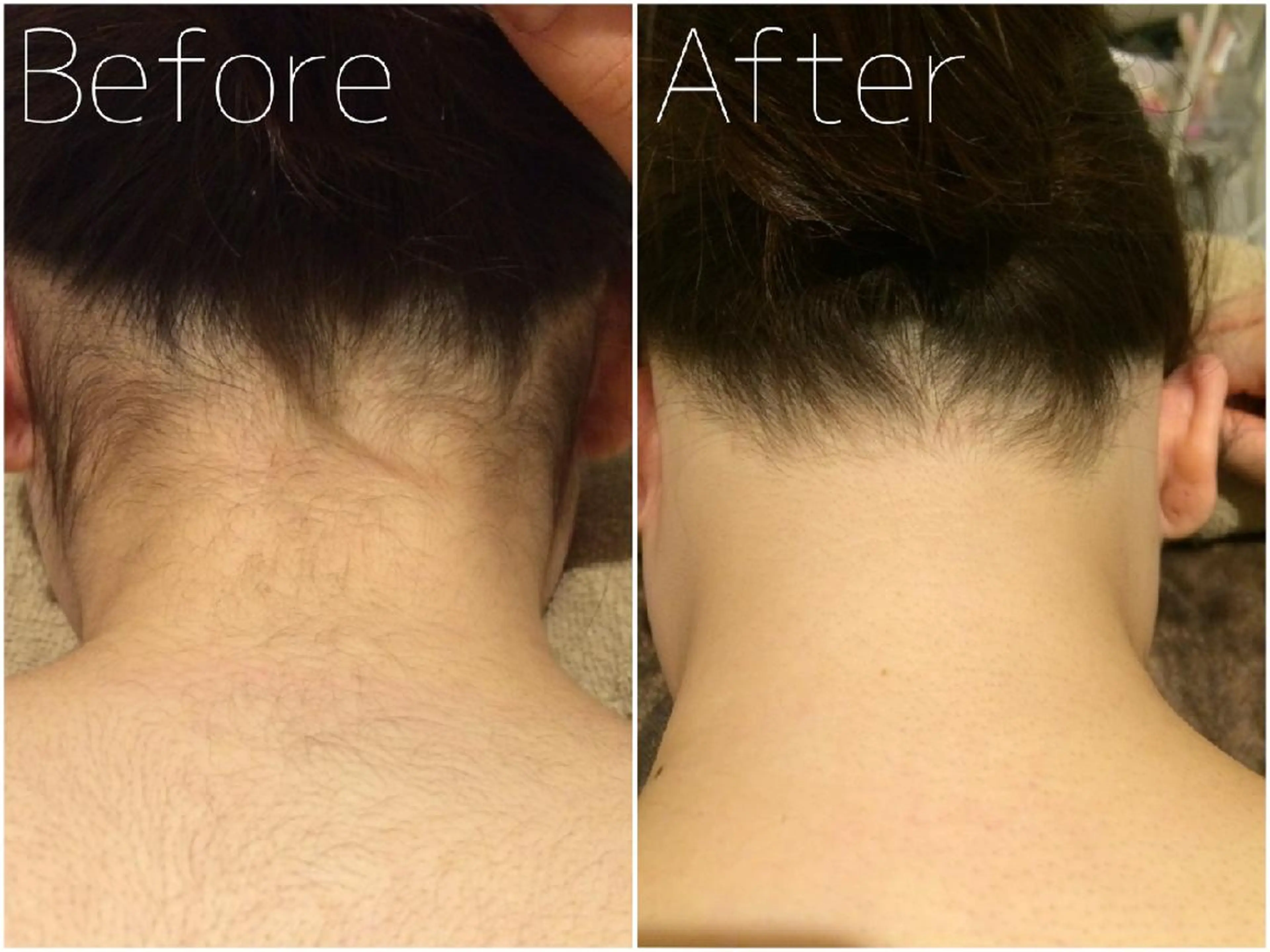 背中脱毛(シェービング込) ￥16,500→￥3,300の写真