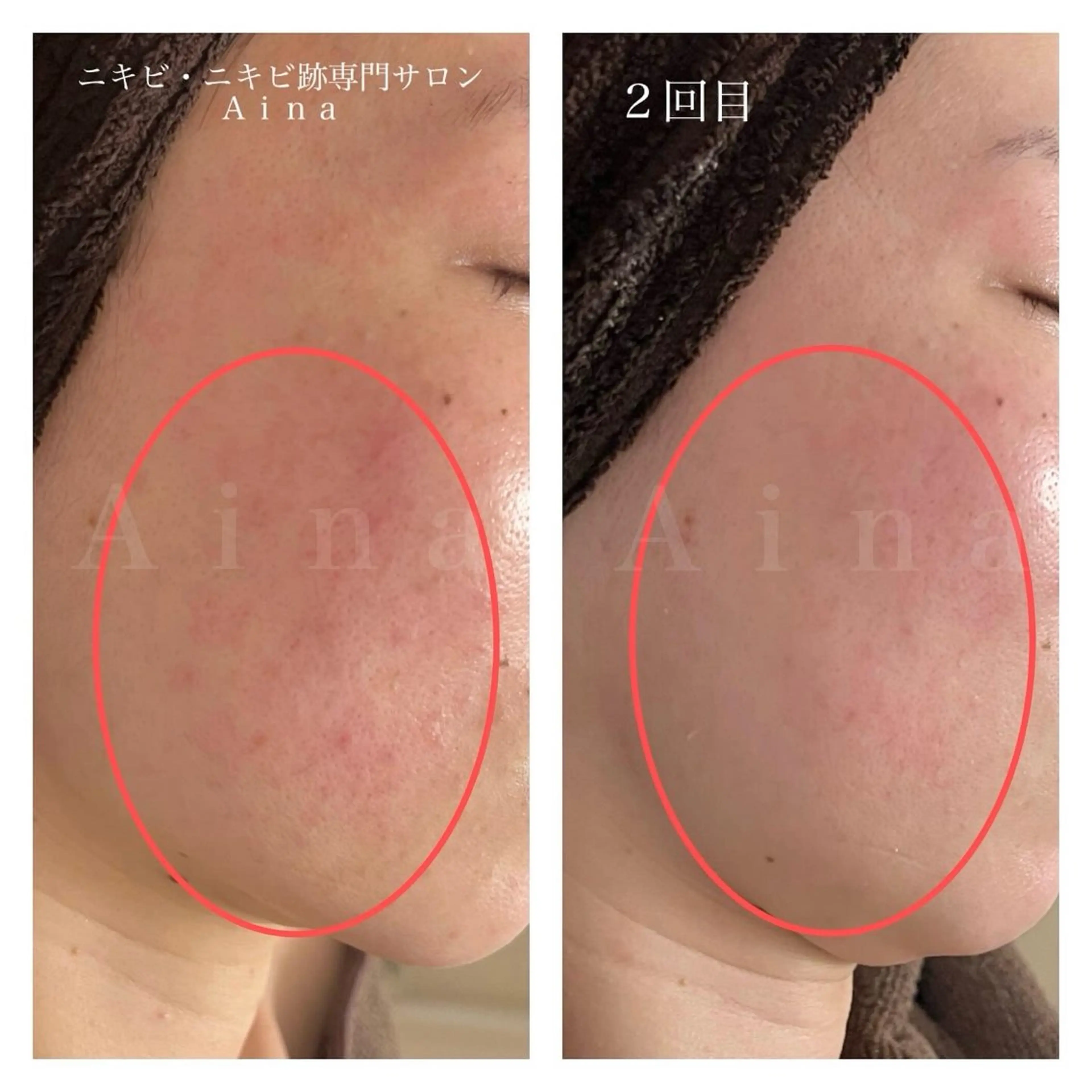 エステ リラク ニキビ跡専門サロン Ainaのエステ・リラクイメージ