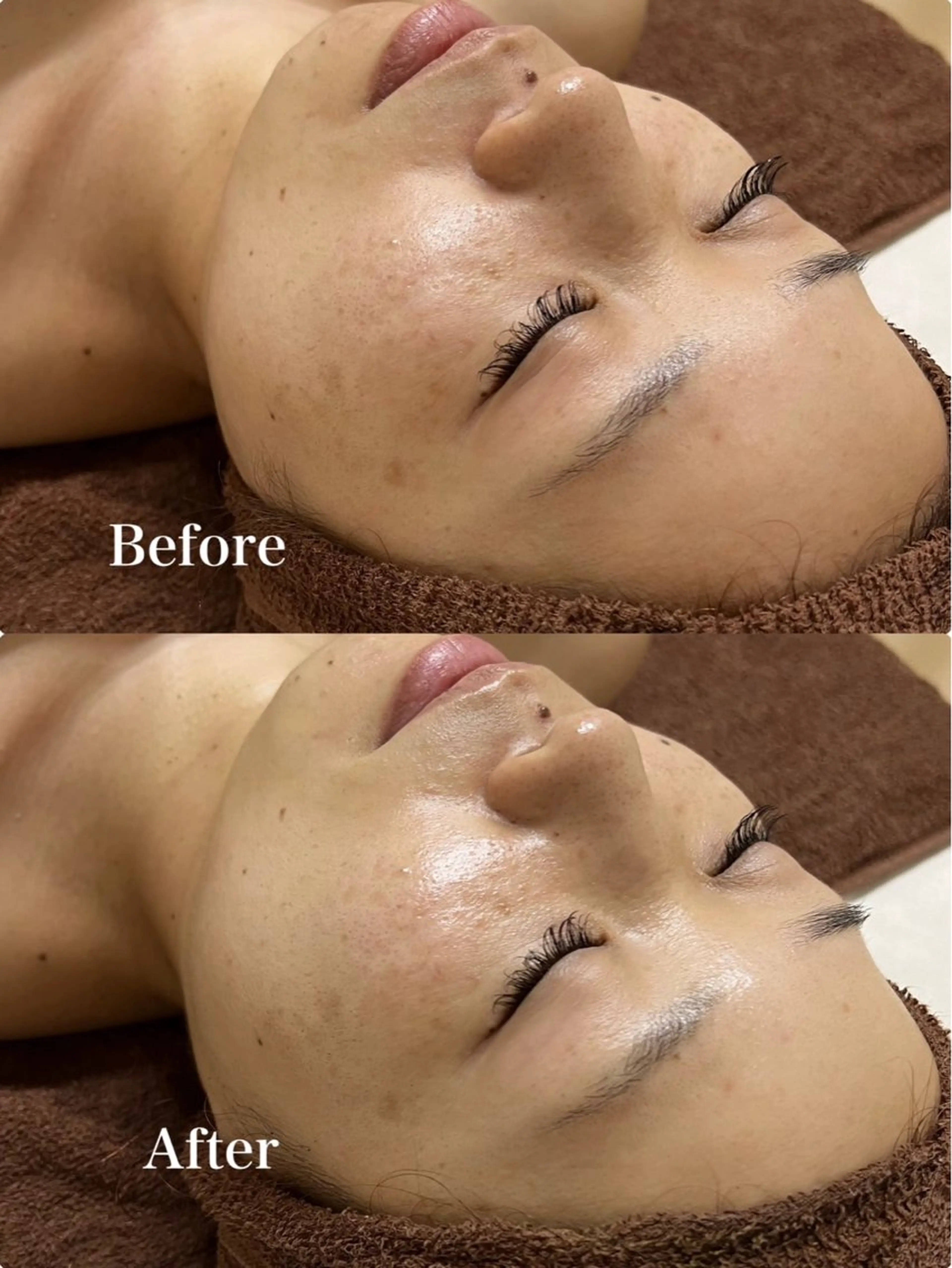 〈お顔〉ハーブピーリング陶器肌【毛穴の黒ずみや美肌ケア】🌿,,の写真