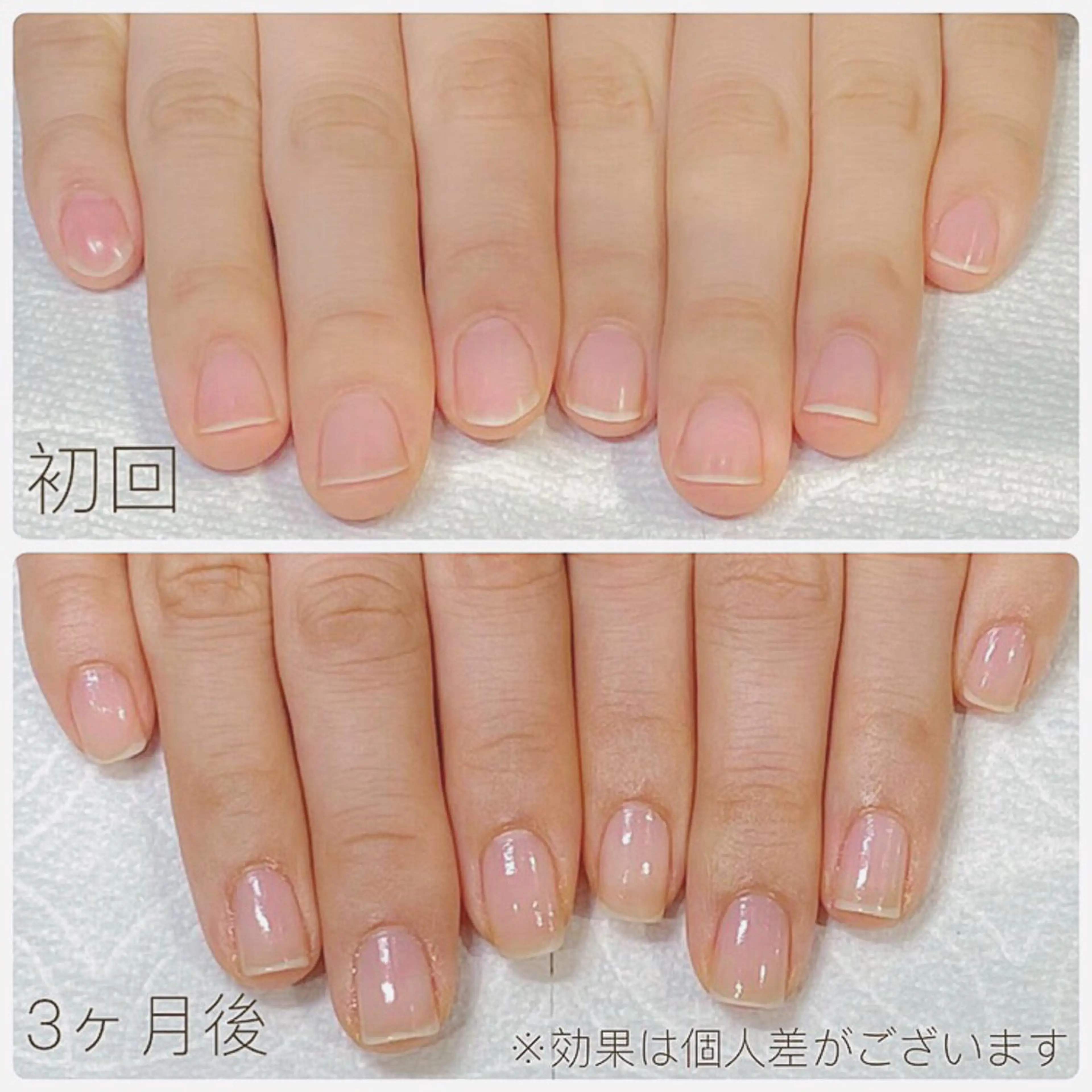 【最強のネイルケア】3ヶ月8回自爪育成コース ✨深爪矯正・自爪育成・爪トラブル✨縦長の美爪に育成✨オフィスネイル◎の写真