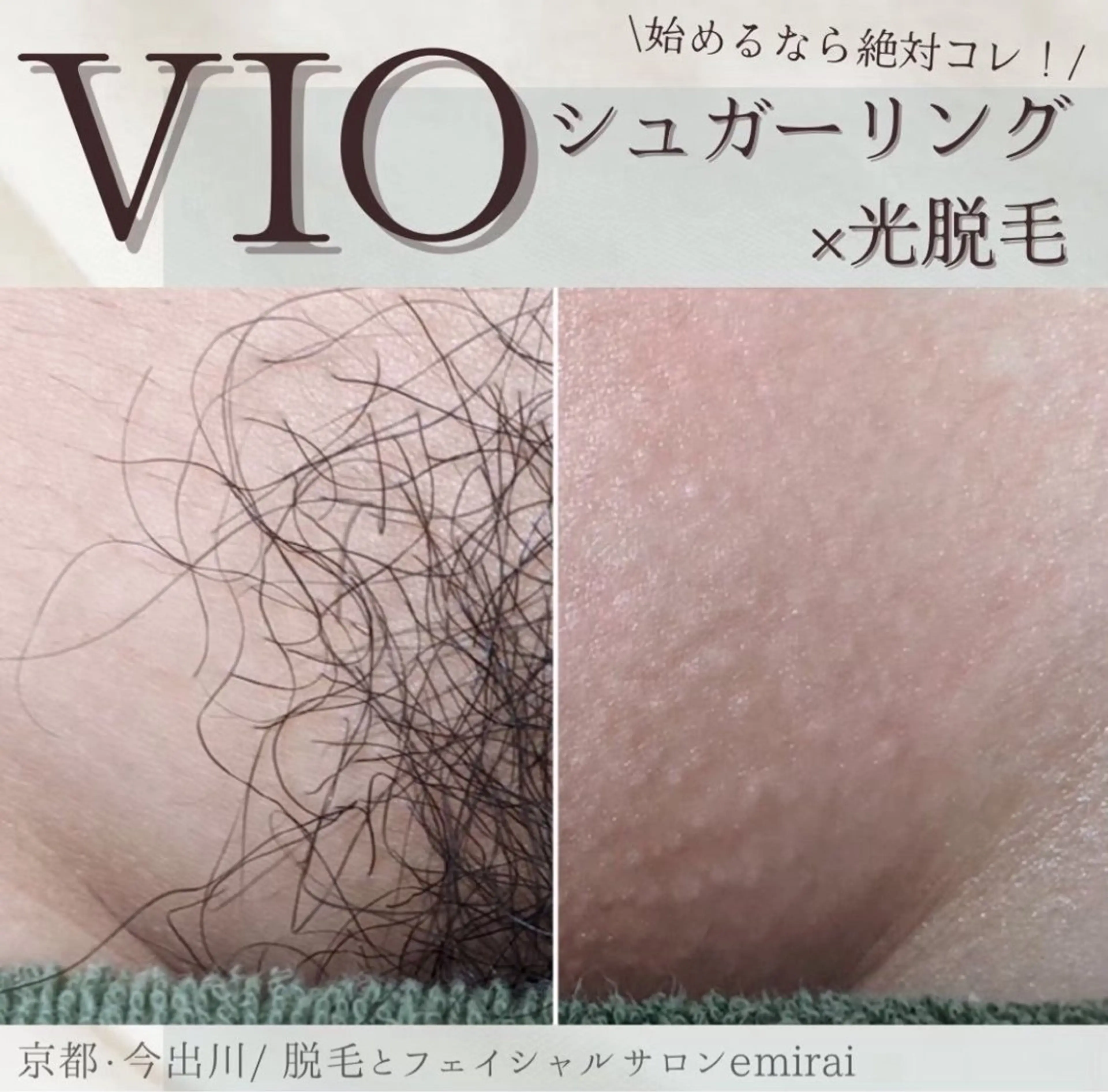 1回でツルツルもち肌に✨シュガーリングVIO脱毛✨お肌に優しいワックス脱毛☺️京都初💎mix脱毛も可の写真