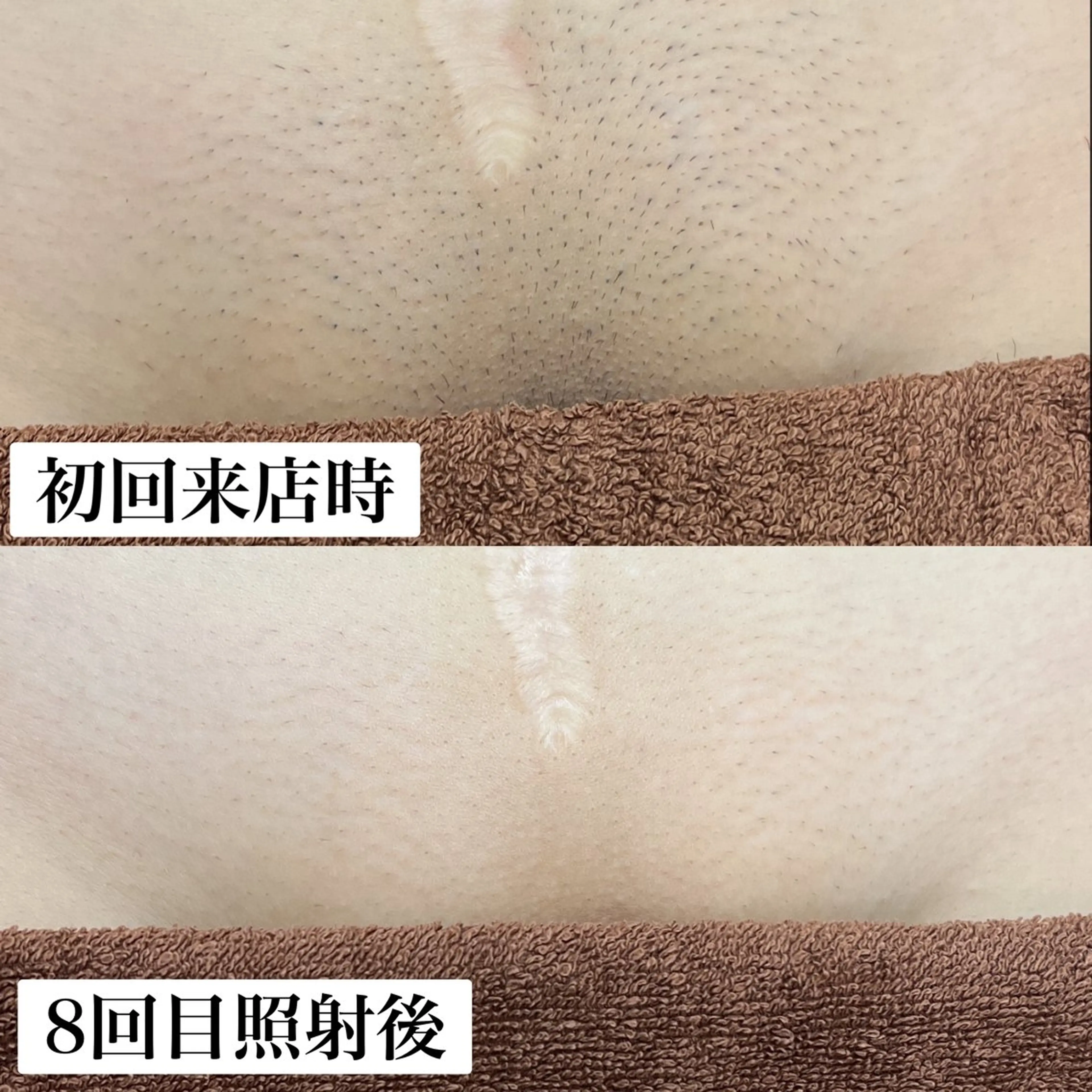 脱毛 毛穴改善/脱毛 ネイル 川上久仁子のエステ・リラクイメージ