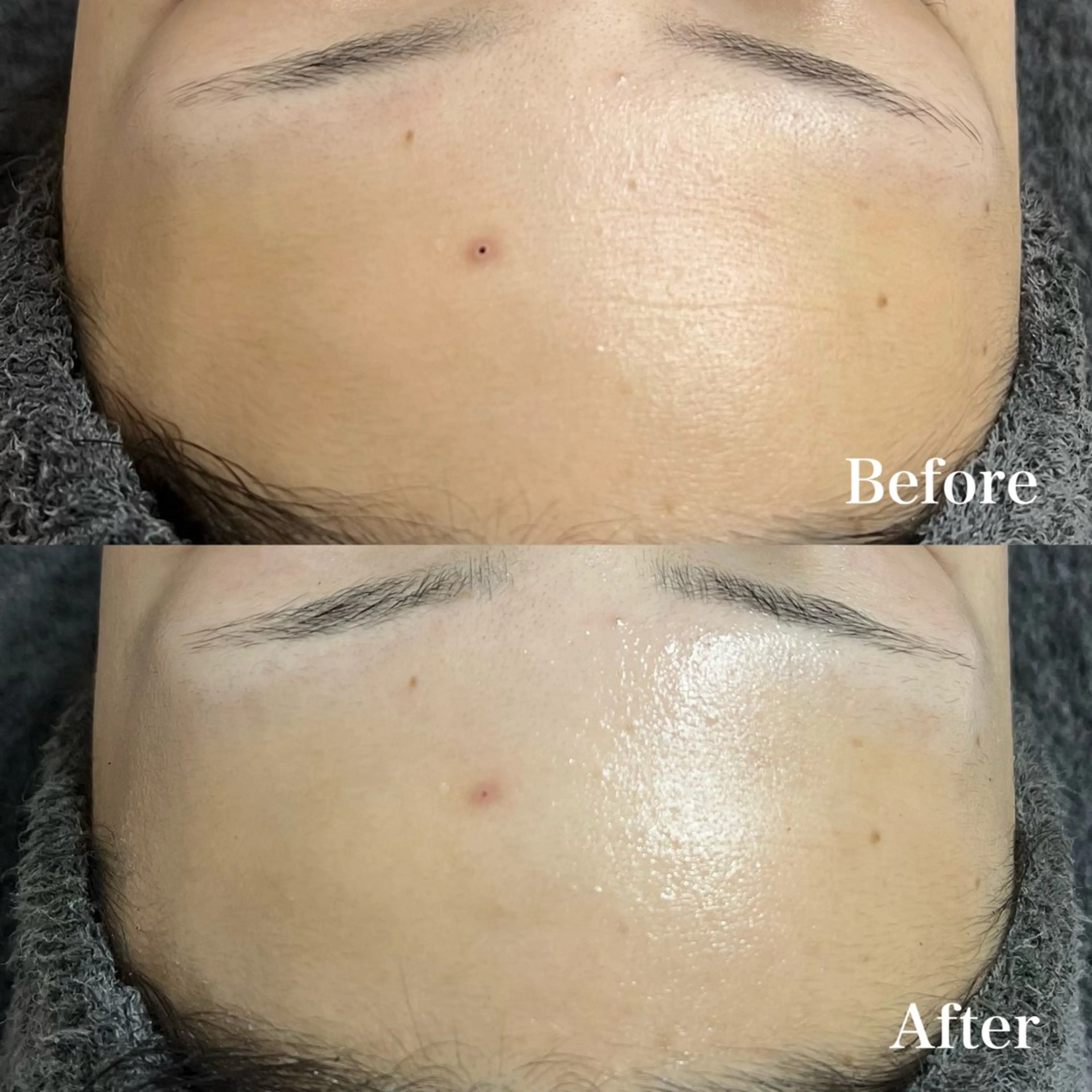 🌹【シワケア・かゆいニキビ・塗るボトックスで】REVIハーブピーリング《陶肌トリートメント》 /➕PRB 0.8mlの写真