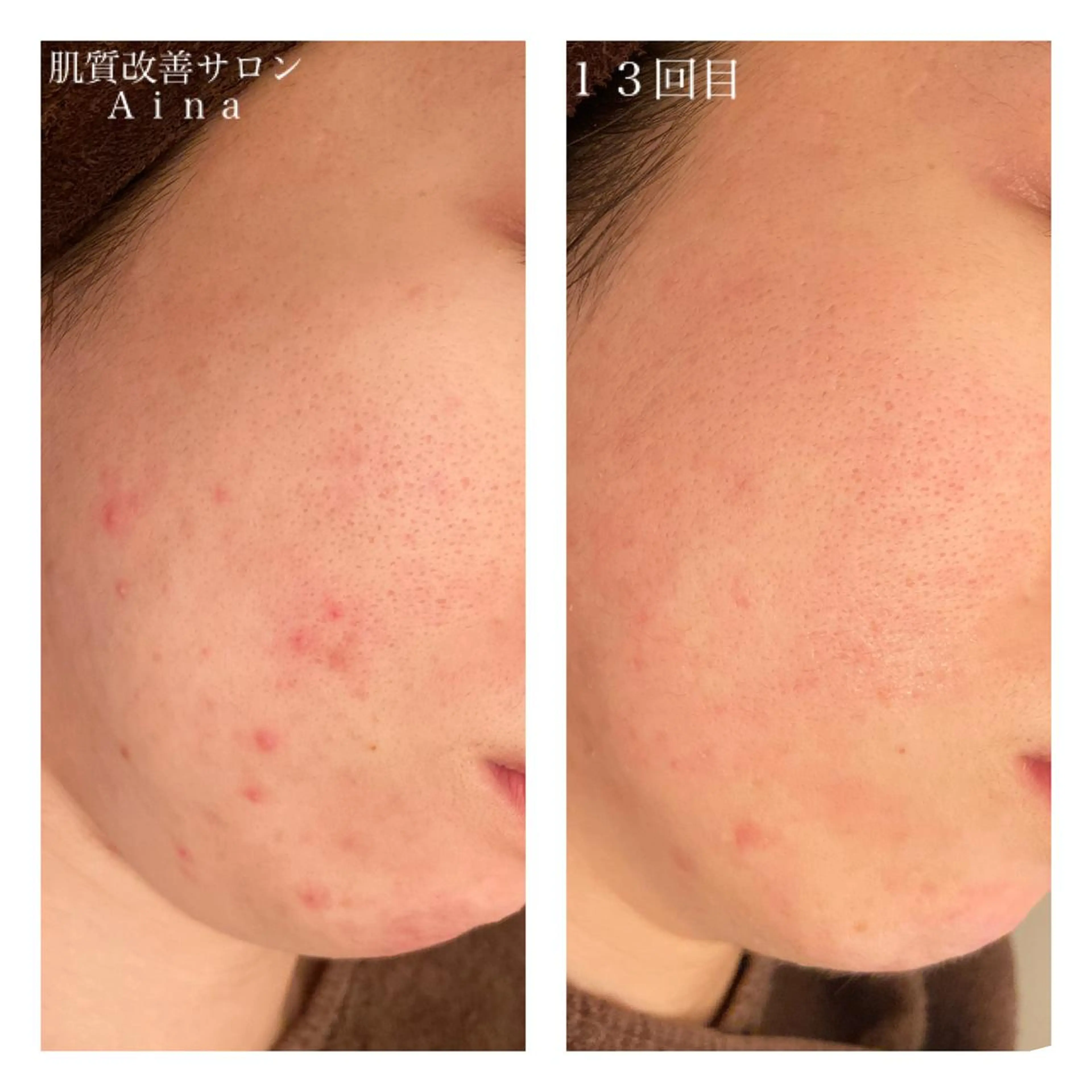 ロング カラー パーマ ヘアアレンジ メンズ ネイル マツエク・マツパ 赤色 ニキビ跡専門サロン Ａｉｎａのエステ・リラクイメージ