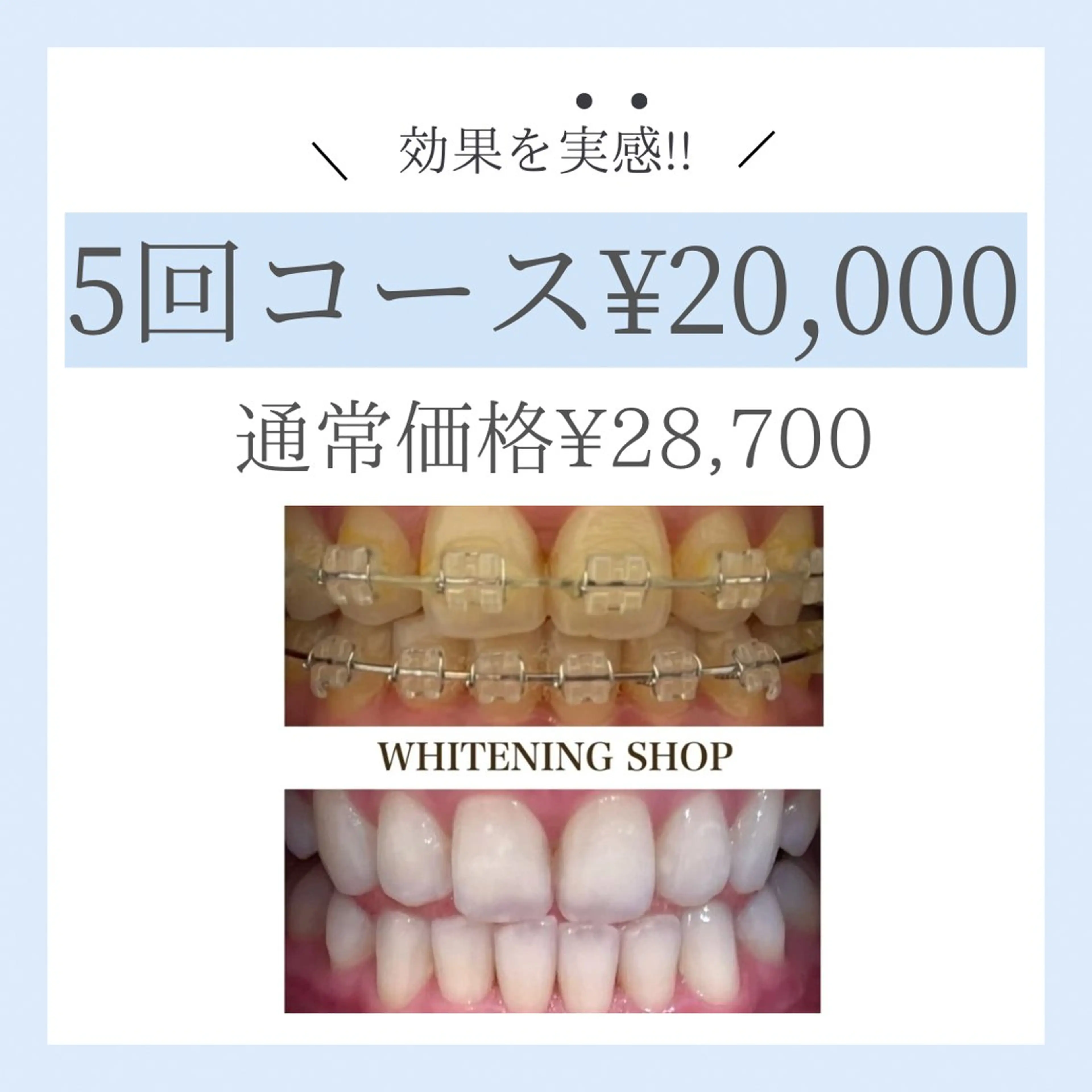 【効果を実感したい方◎】セルフホワイトニング40分×5回 (¥4000/回)¥28700→¥20000の写真