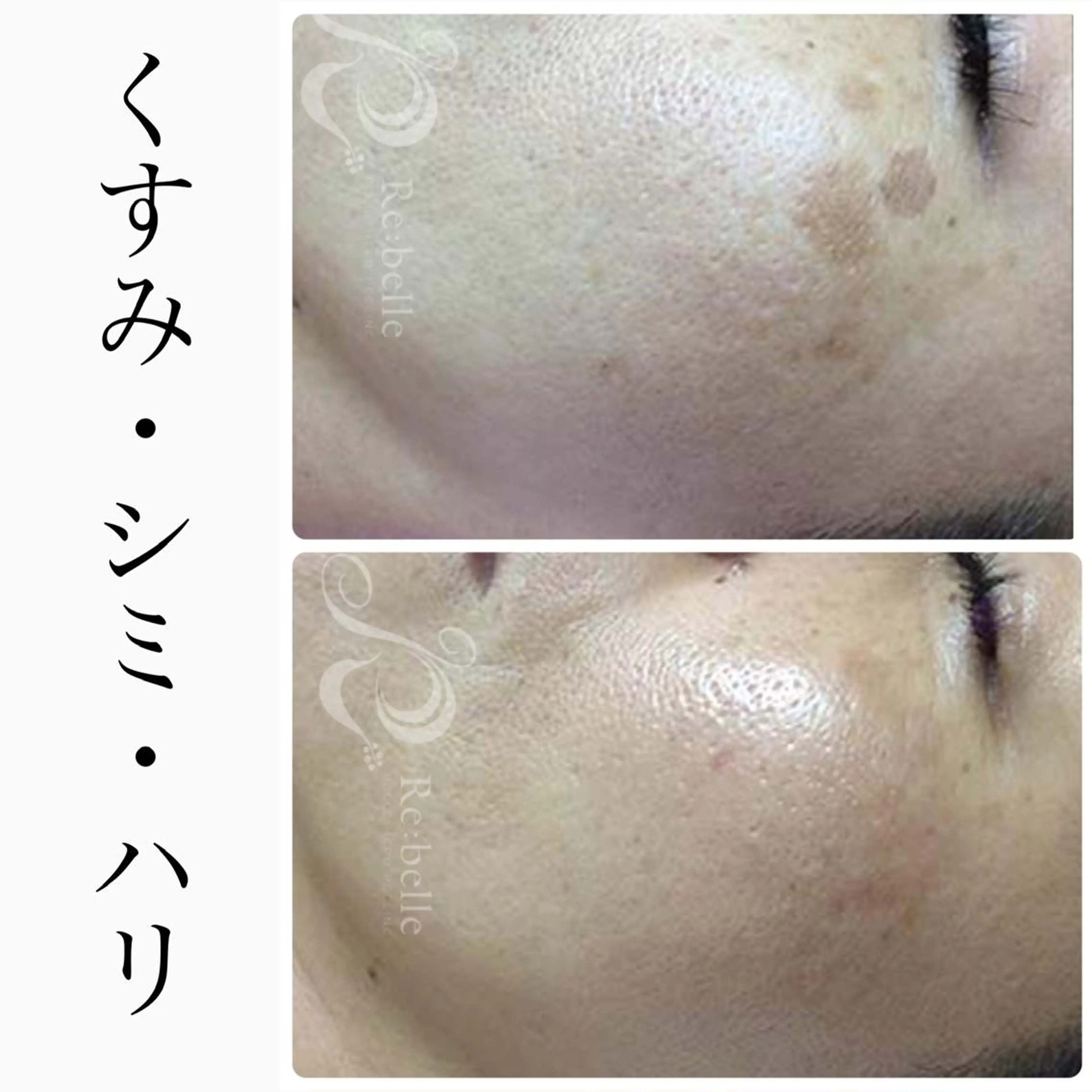 エステ BeSkin藤沢店所属・ニキビ/肌質改善 BeSkin 藤沢店のエステ・リラクイメージ