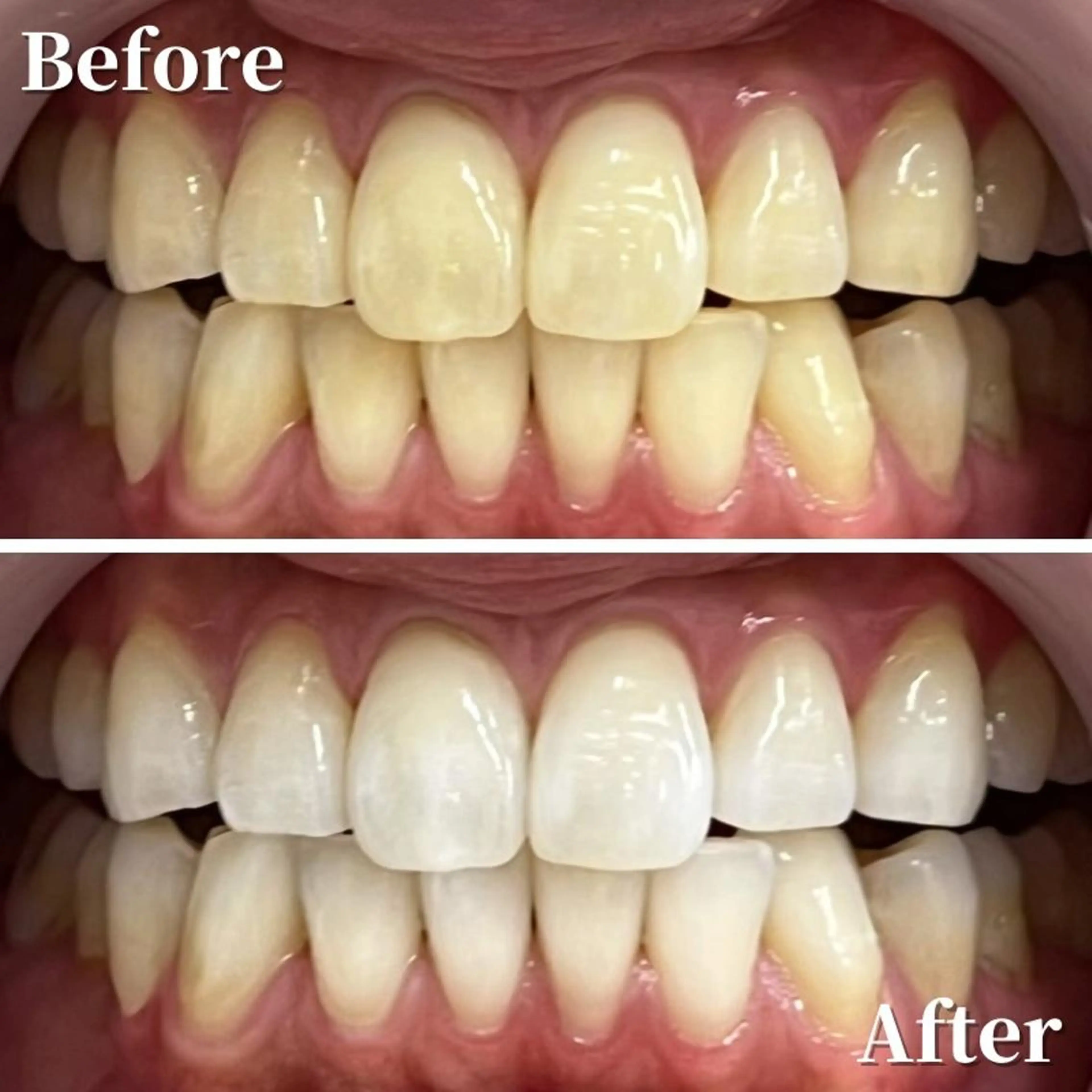 💛早さ＆効果に自信あり💛通常の2倍の照射パワーで即効性抜群‼️最新ハイパワーセルフホワイトニング5分照射×4回🦷✨の写真