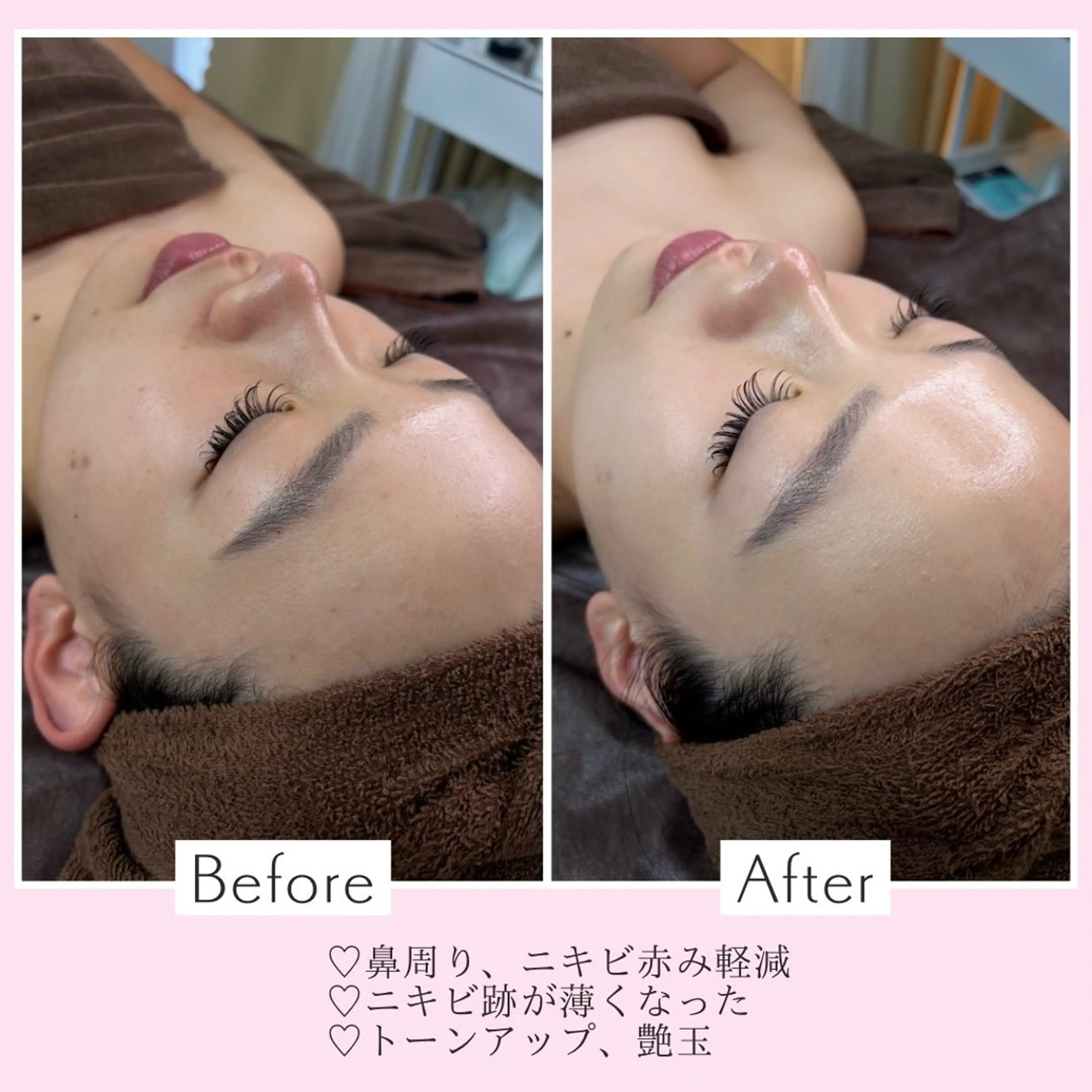 当日限定価格‼️ 韓国式美肌毛穴洗浄＆うるツヤ韓国ピーリング(剥離なし)の写真