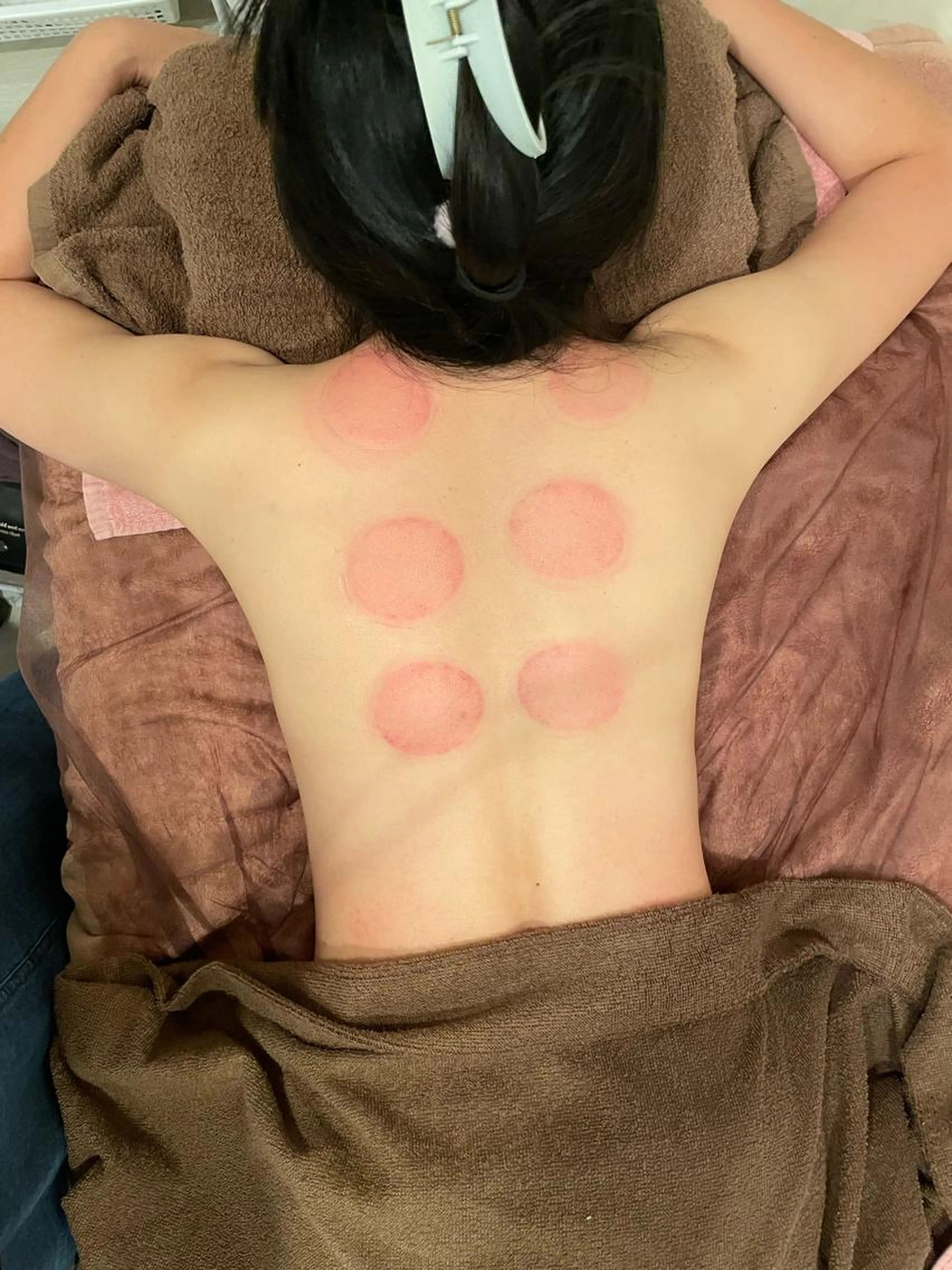 カッピングの写真