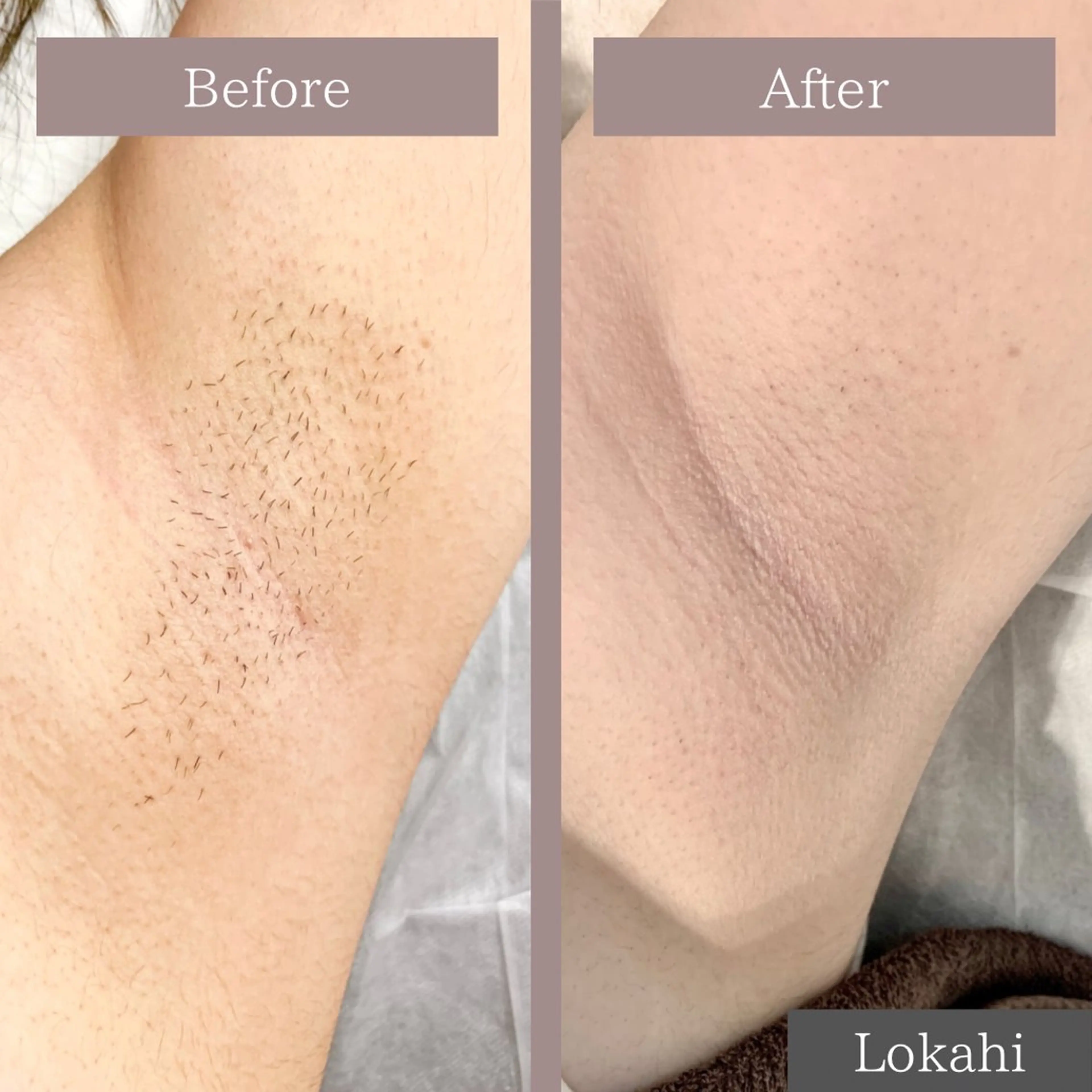 脱毛 Lokahi所属・リラク/エステ Lokahiのエステ・リラクイメージ