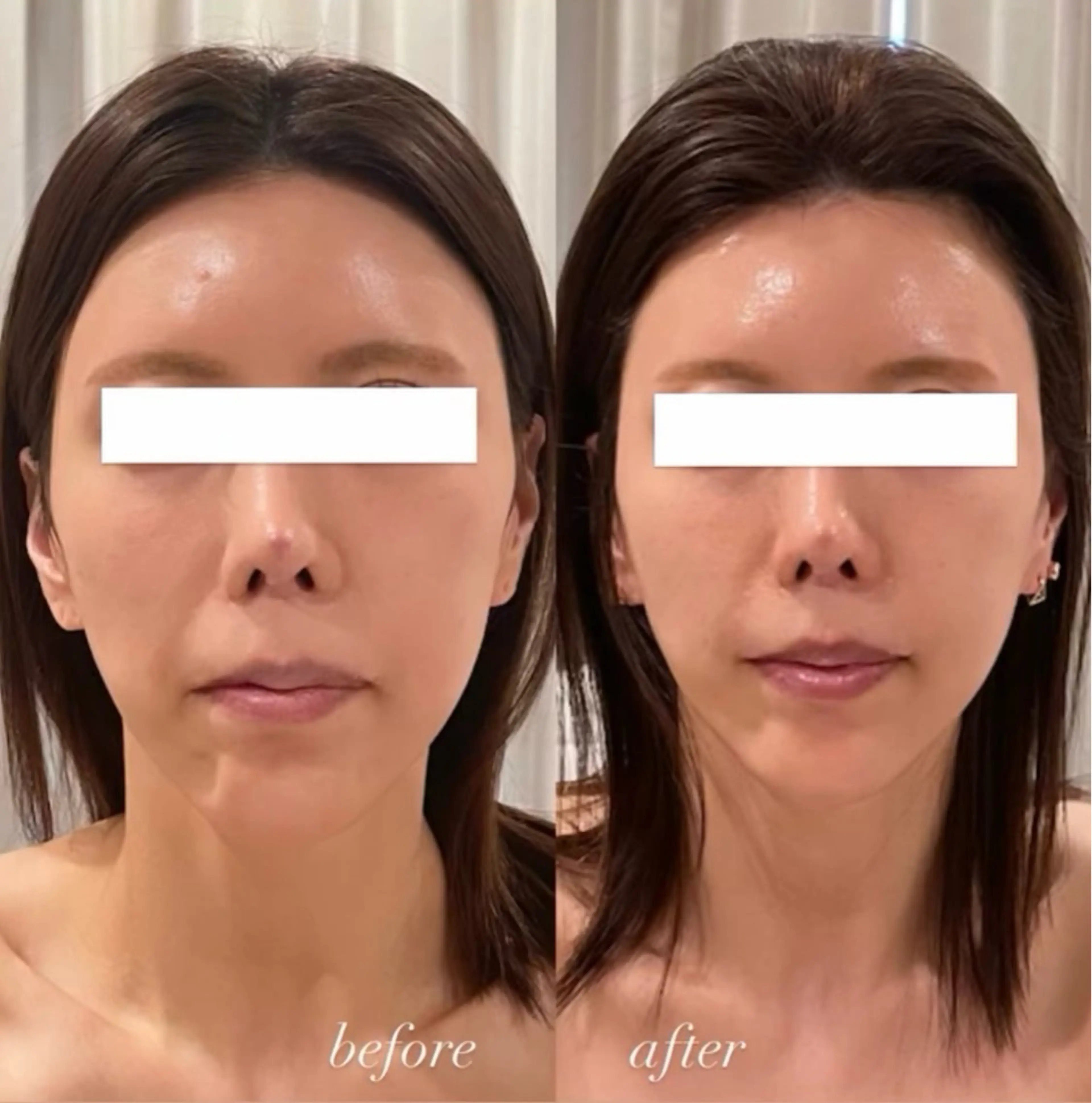 エステ 小顔/たるみ/黒ずみ除去専門サロン/SONA 大和西大寺店所属・【小顔専門看護師 サロンSONA】のエステ・リラクイメージ