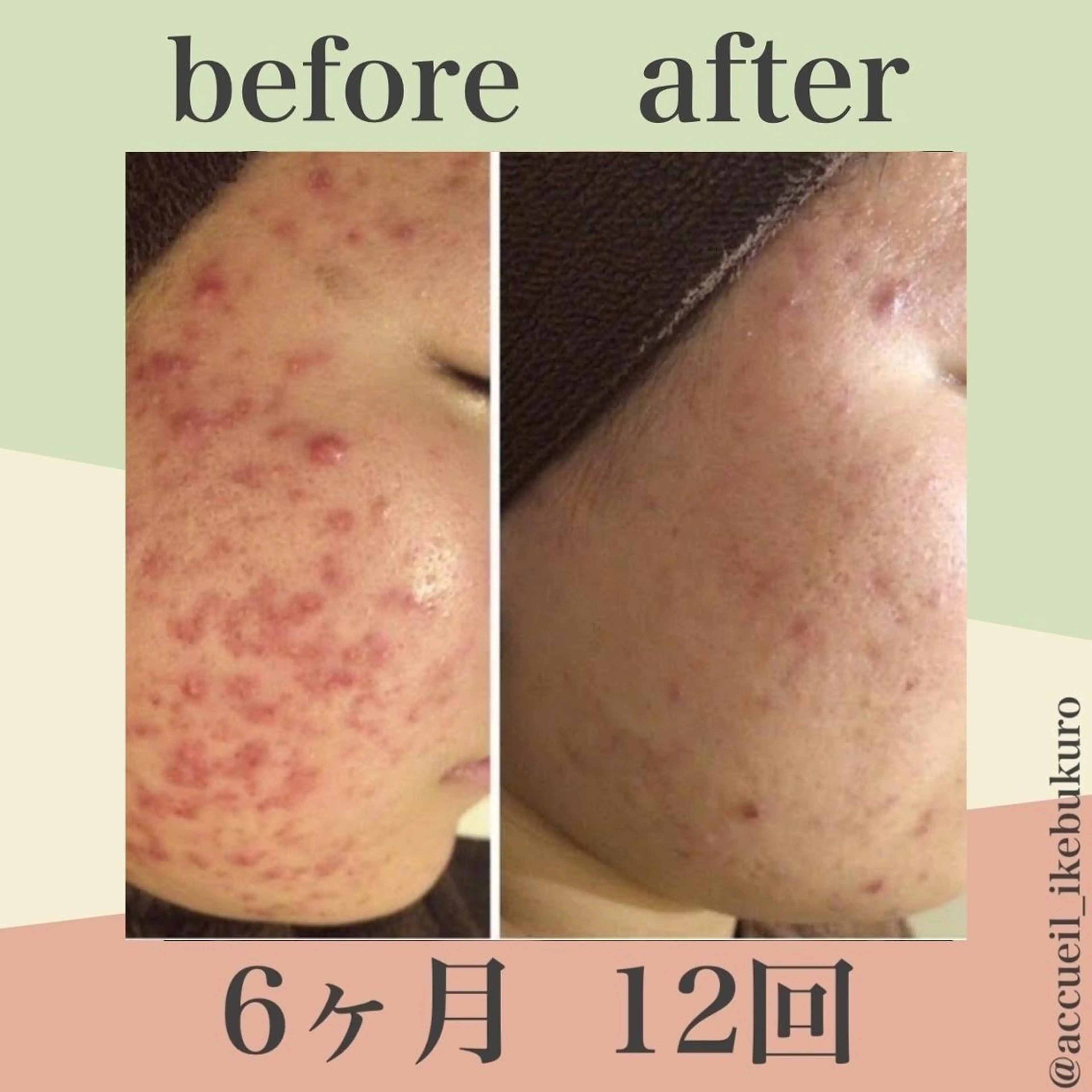 ニキビ跡改善専門🔥 医療にはできない改善のエステ・リラクイメージ