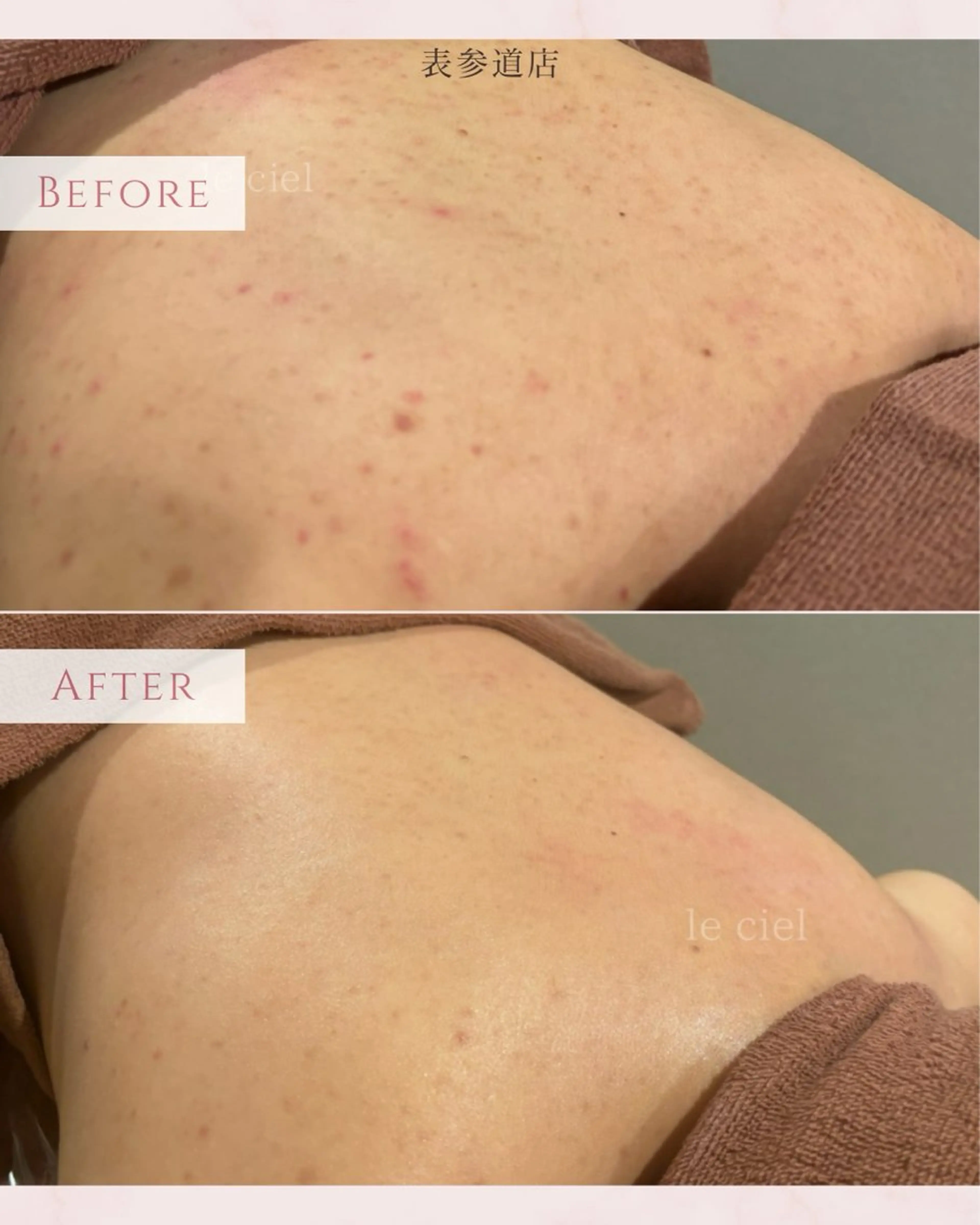 【背中上半】ニキビ/ザラツキ　毛穴洗浄の写真