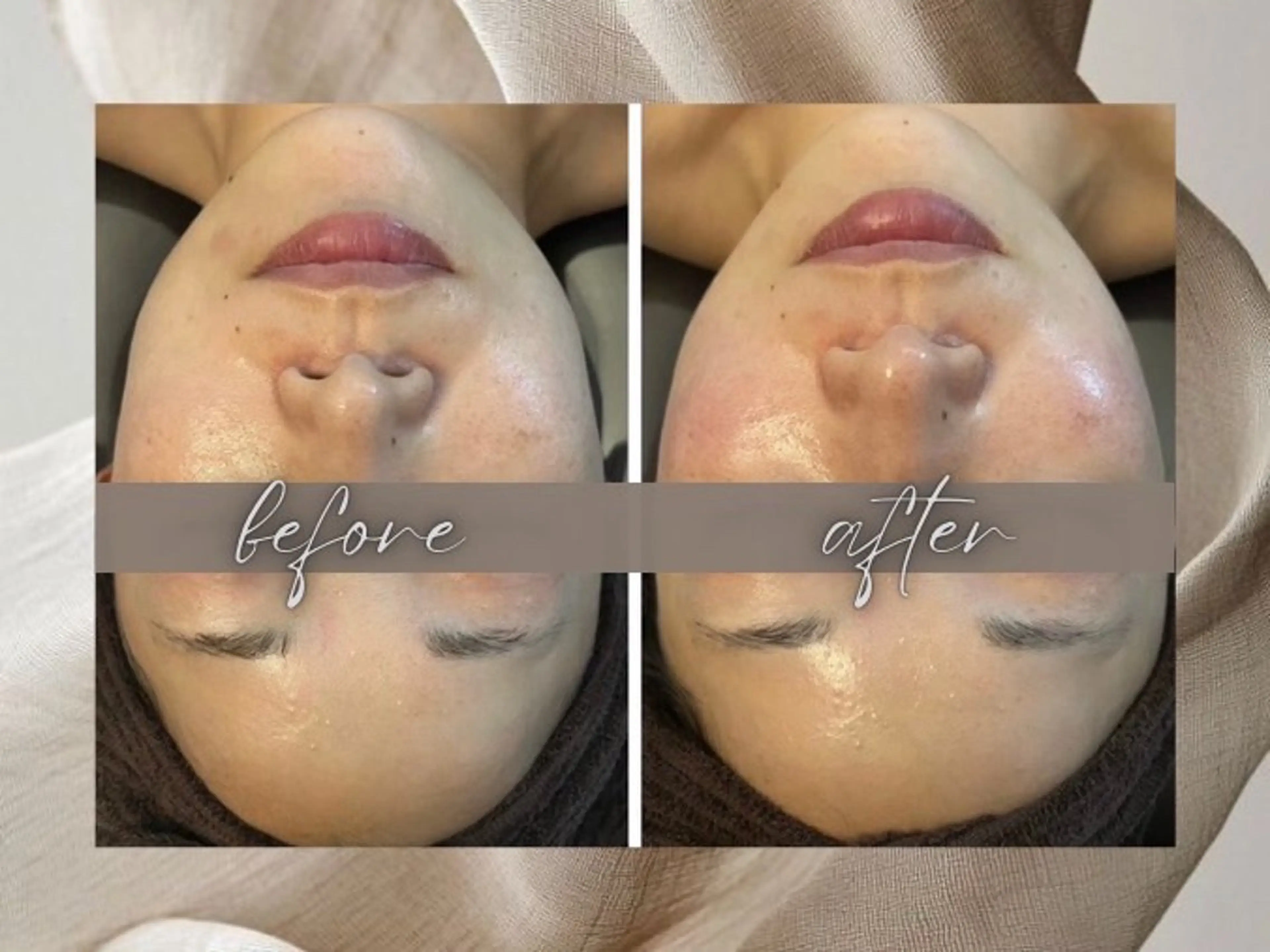 小顔・毛穴/ニキビ/ ハーブピーリング専門のエステ・リラクイメージ