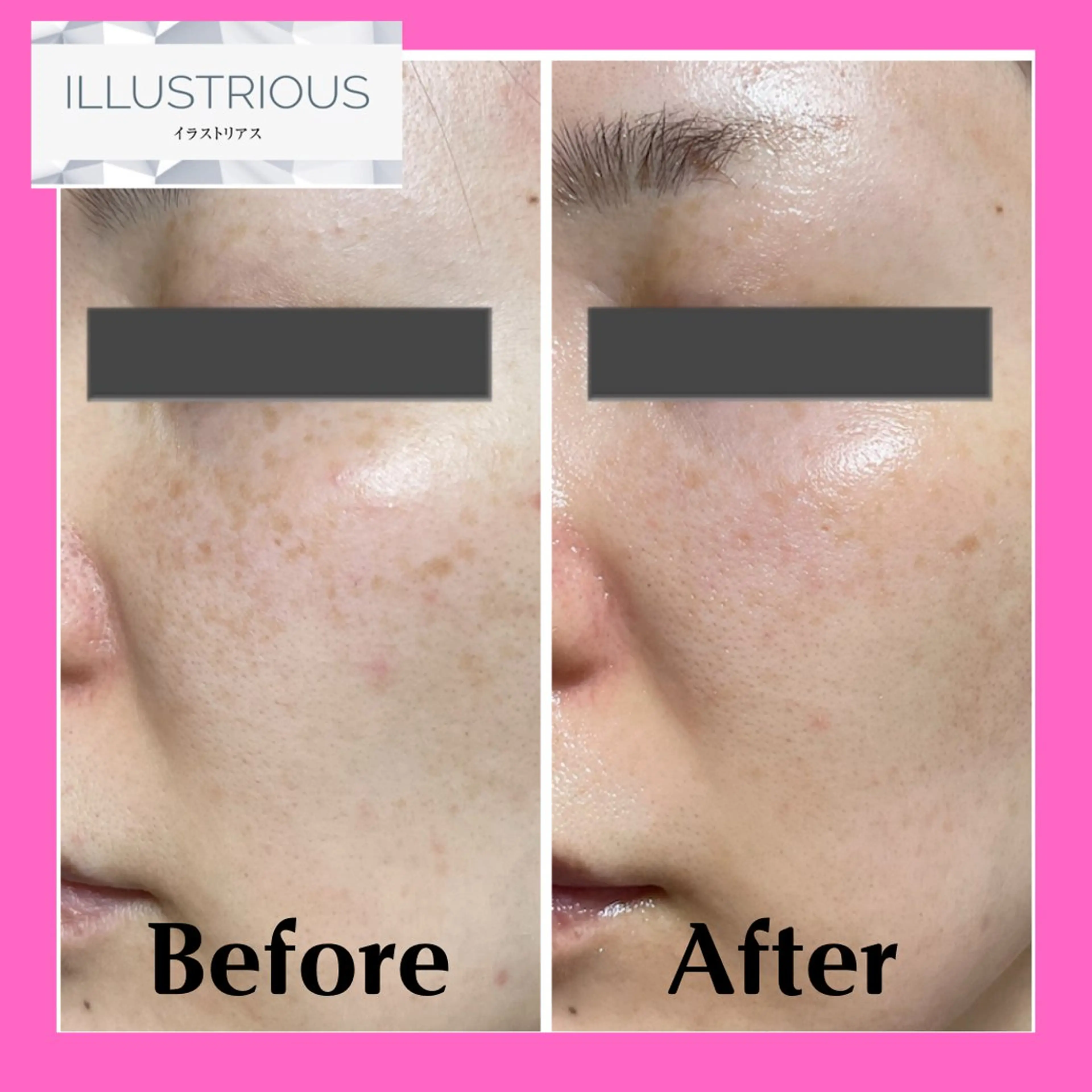 【クリスティーナ💙イラストリアス】❄️シミ・美白ピーリング・黒ずみ毛穴レス🫧¥24,200⇒¥12,000の写真