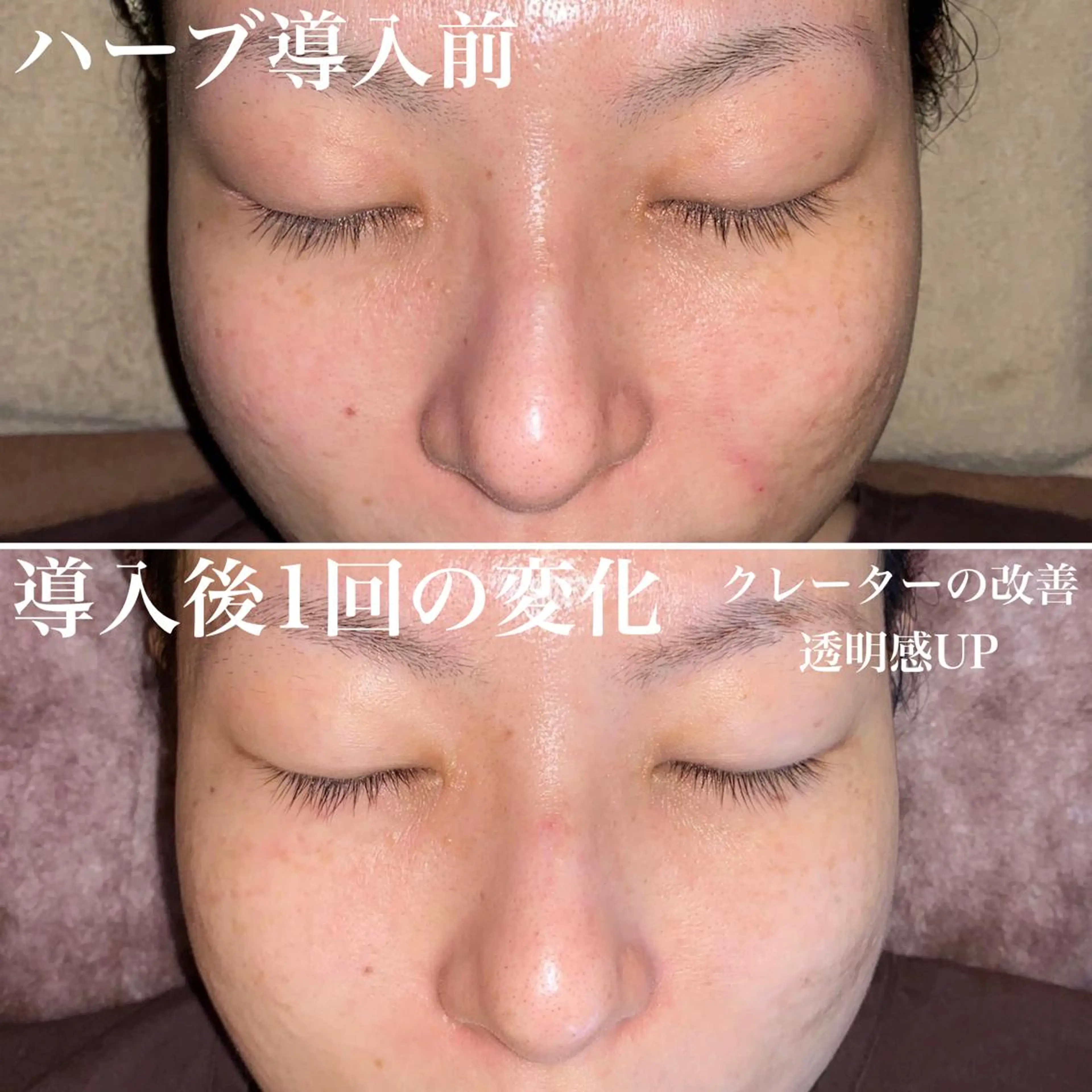 ロング カラー パーマ ヘアアレンジ メンズ キッズ ネイル マツエク・マツパ アイブロウ 透明感カラー 即小顔♥️美容鍼× ハーブピーリングのその他イメージ