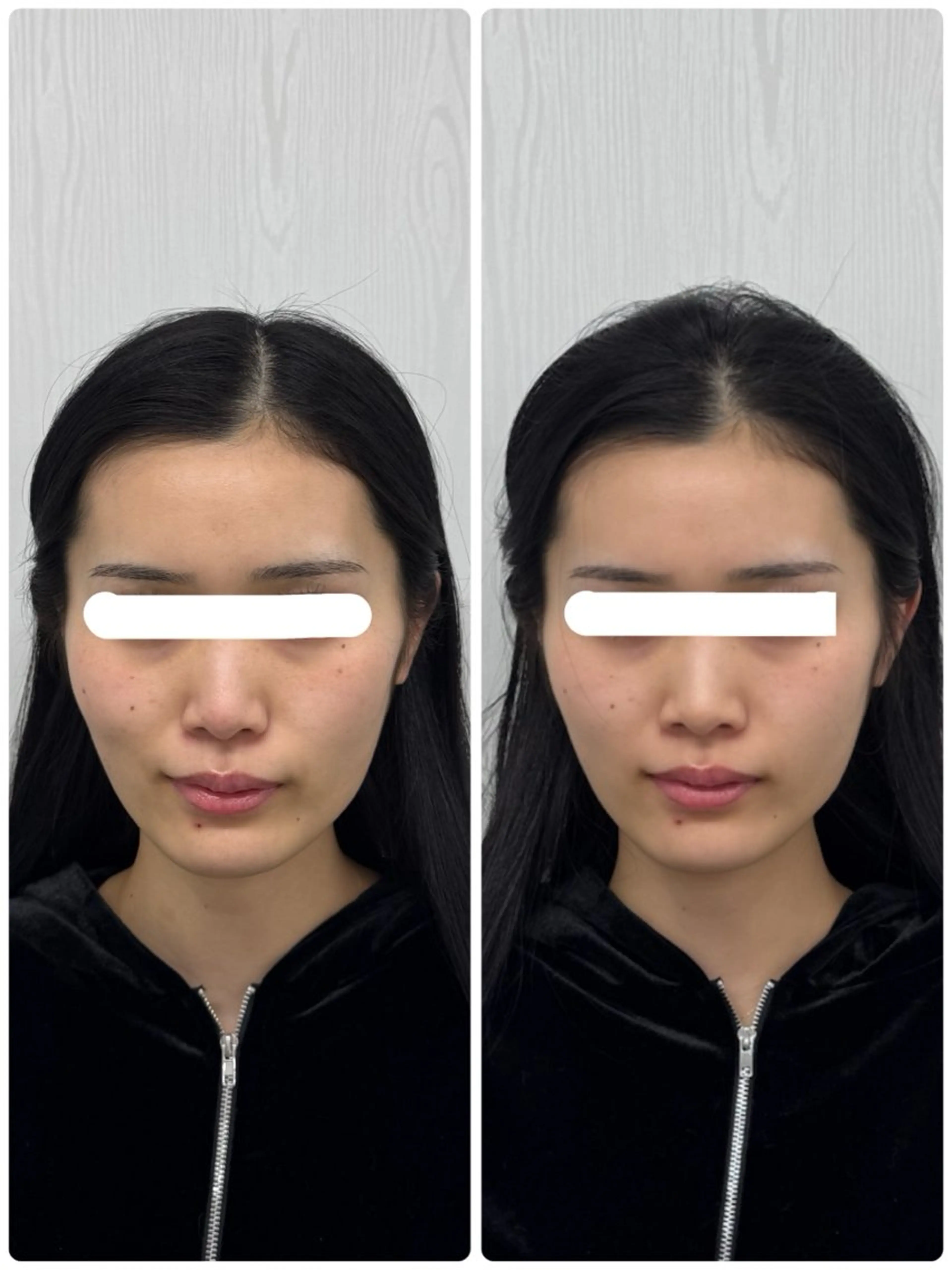 美容鍼×小顔矯正 ×美容整体　浜川泰仁のエステ・リラクイメージ