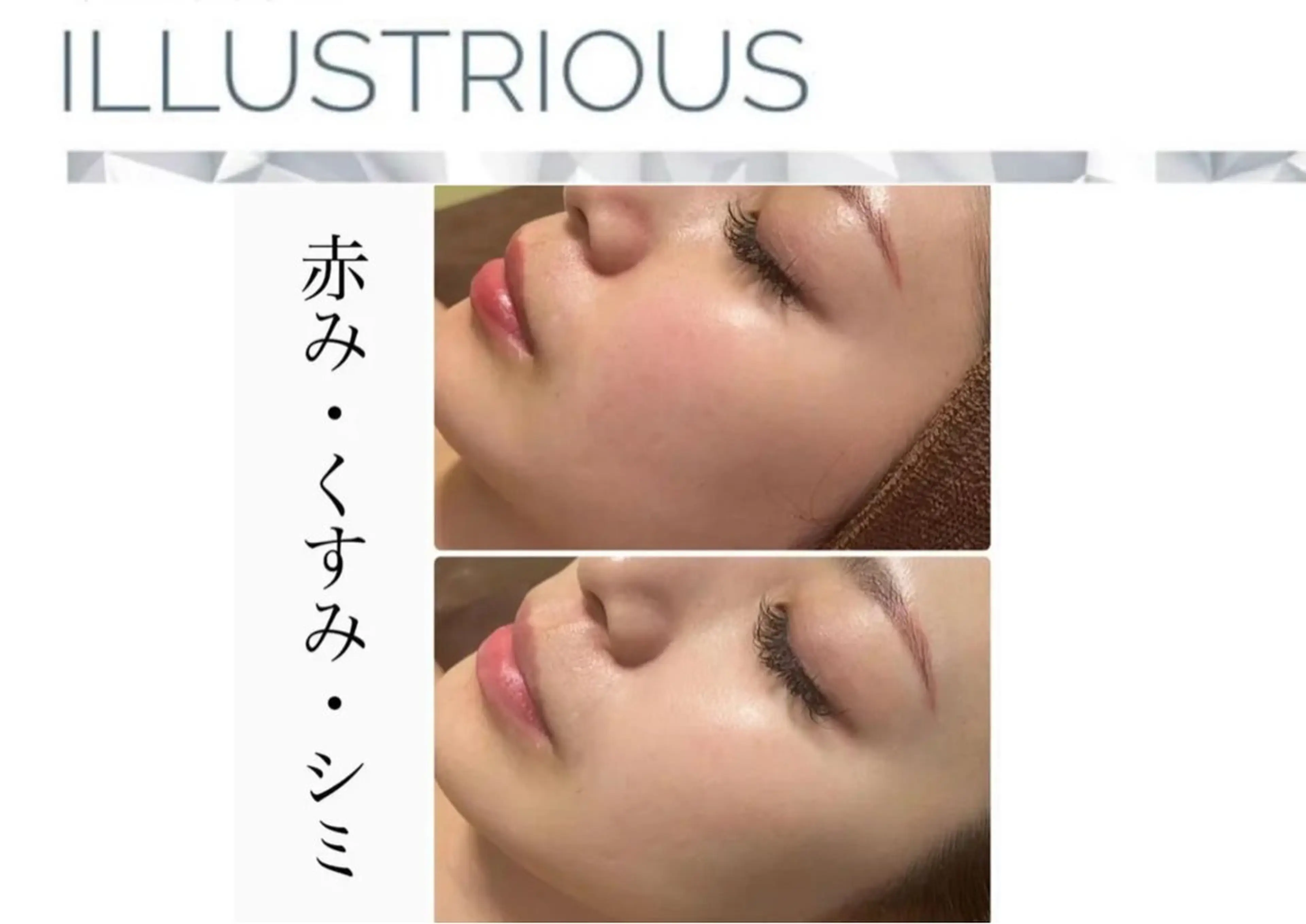 【美白/くすみケア】ビタミンピーリング×マッサージ×複数パック(クリスティーナ/イラストリアス)驚きの2トーンup透明感の写真