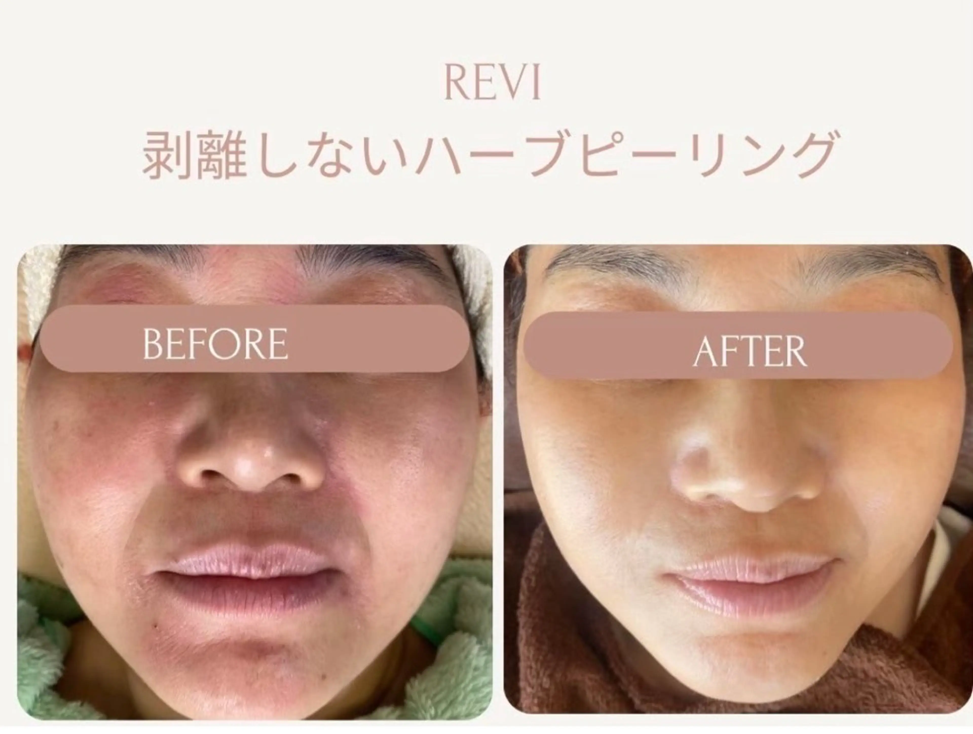 《年齢肌お悩みコース》の写真