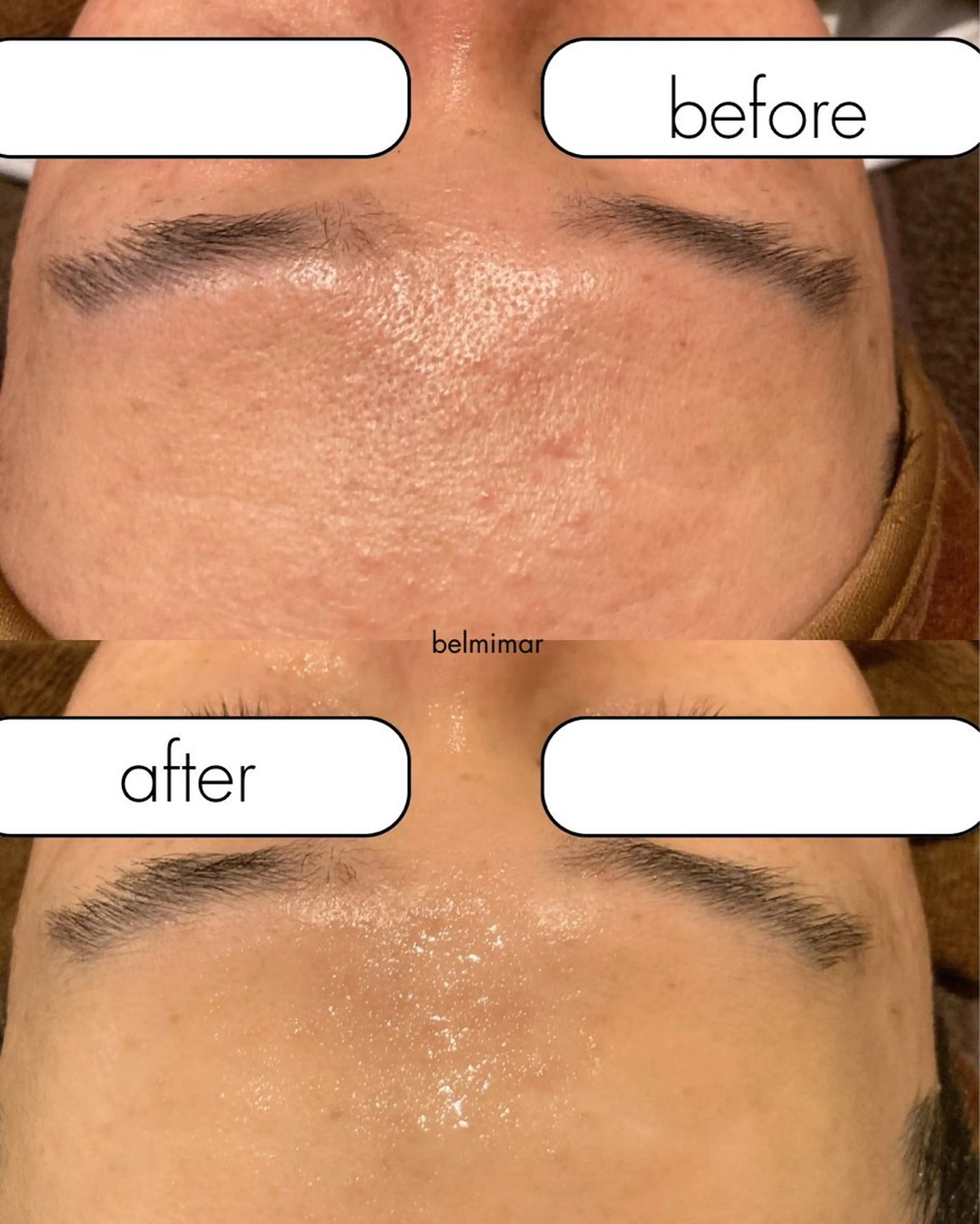 セラピール＋毛穴汚れ取り＋パック【毛穴・ニキビ・肌艶】低刺激韓国NO1人気ピール🇰🇷💕化粧ノリ抜群◎圧倒的美肌✨の写真