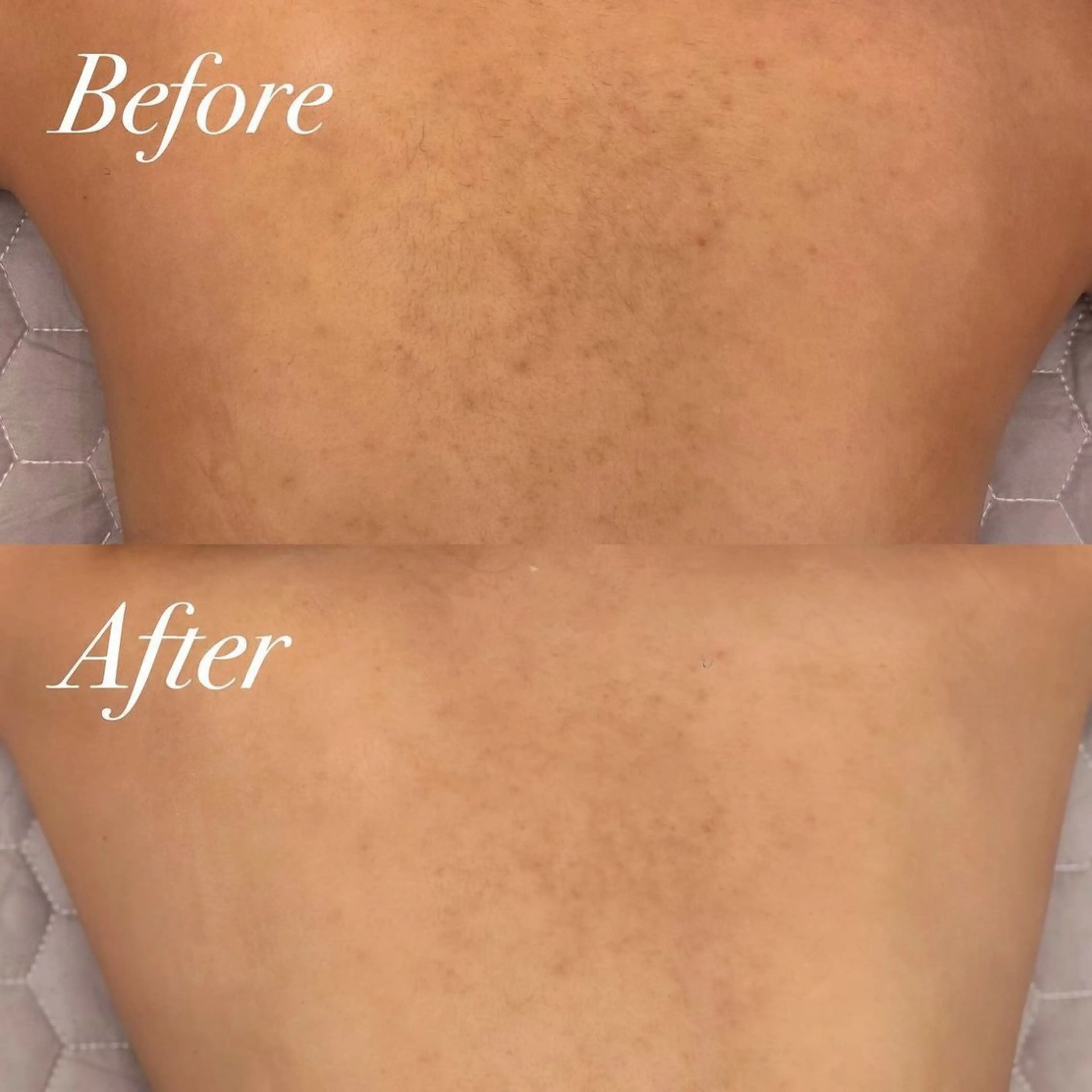 REVIハーブピーリング　背中の写真