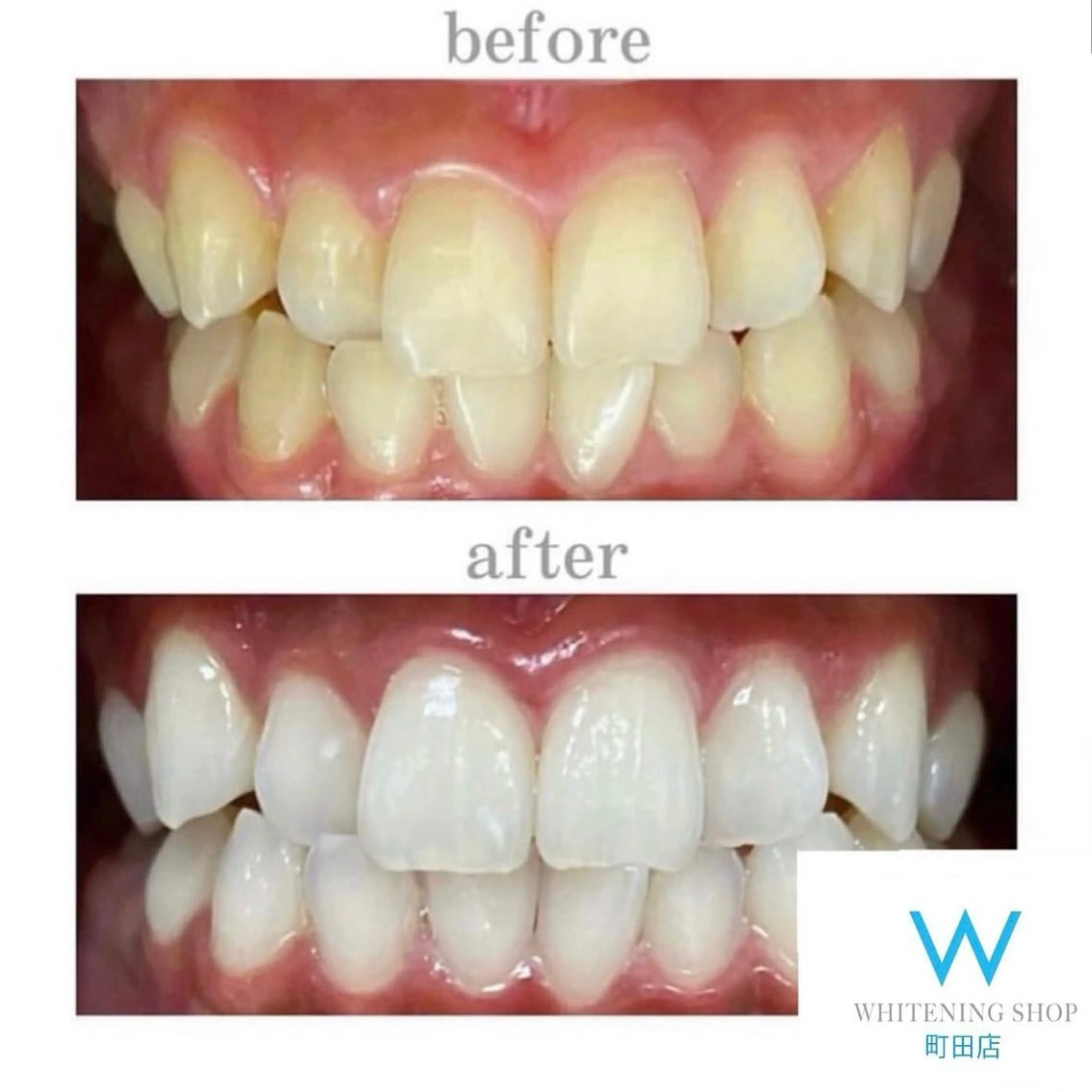 【初めての方】レディース割★セルフホワイトニング新規様限定1セット(40分)¥6980→¥2500※口コミ条件の写真