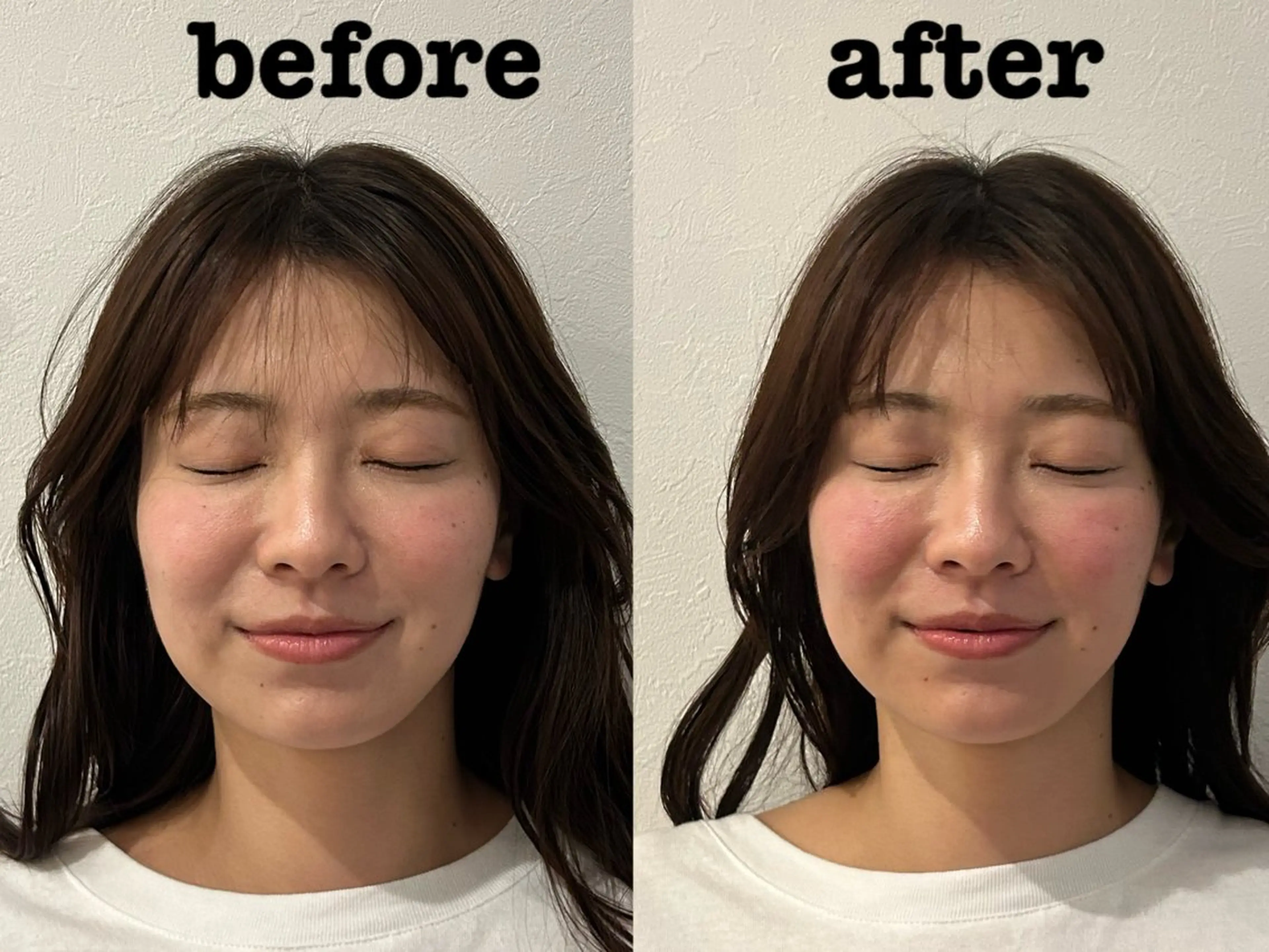 【年齢肌のお悩みに】たるみ・毛穴・ほうれい線　美容鍼（百華鍼）+小顔矯正の写真