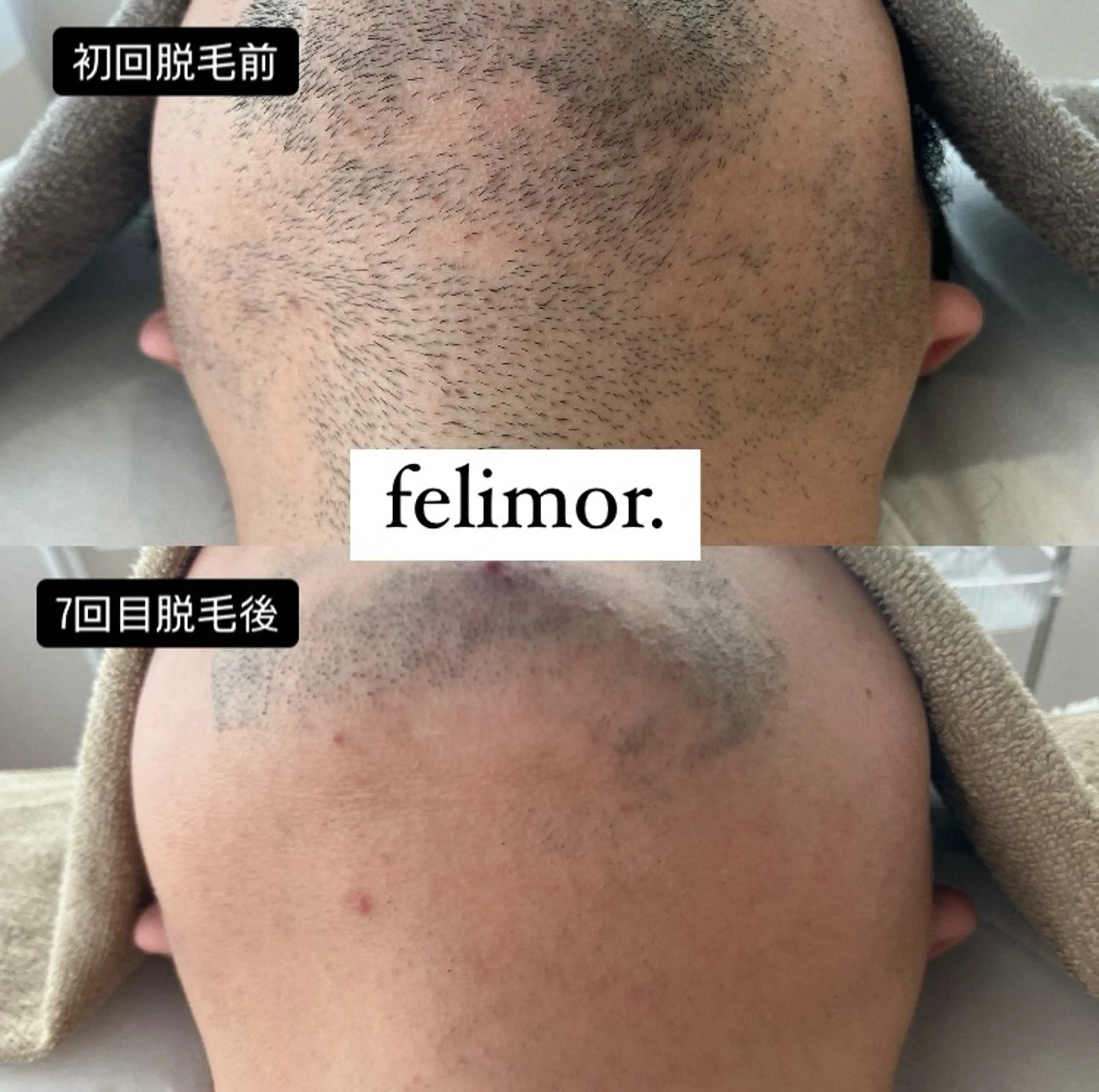 脱毛 Felimor.所属・Felimor. フェリモールのエステ・リラクイメージ