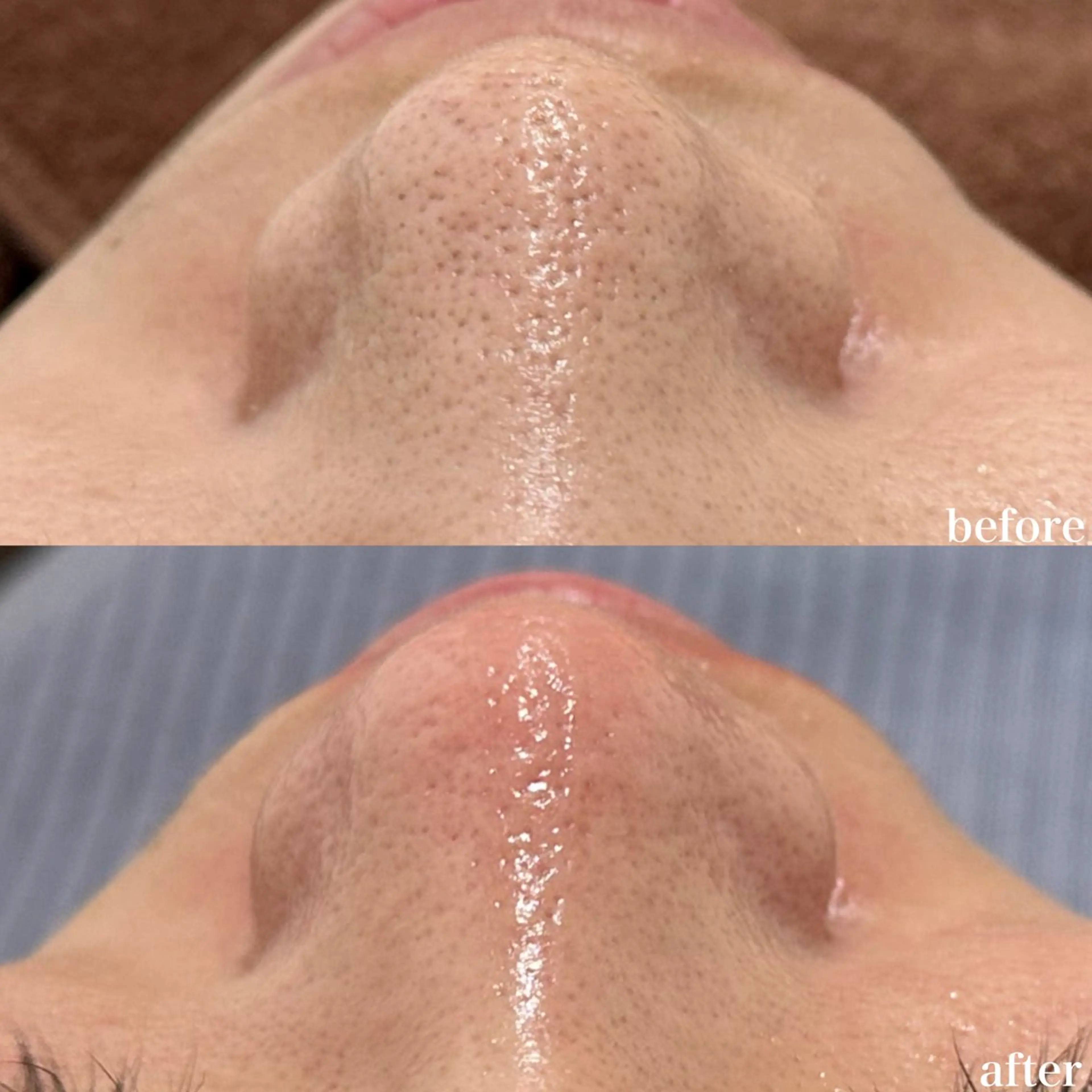 5月限定【毛穴専用】毛穴の汚れや皮脂・ザラつき徹底改善(クリスティーナ)の写真