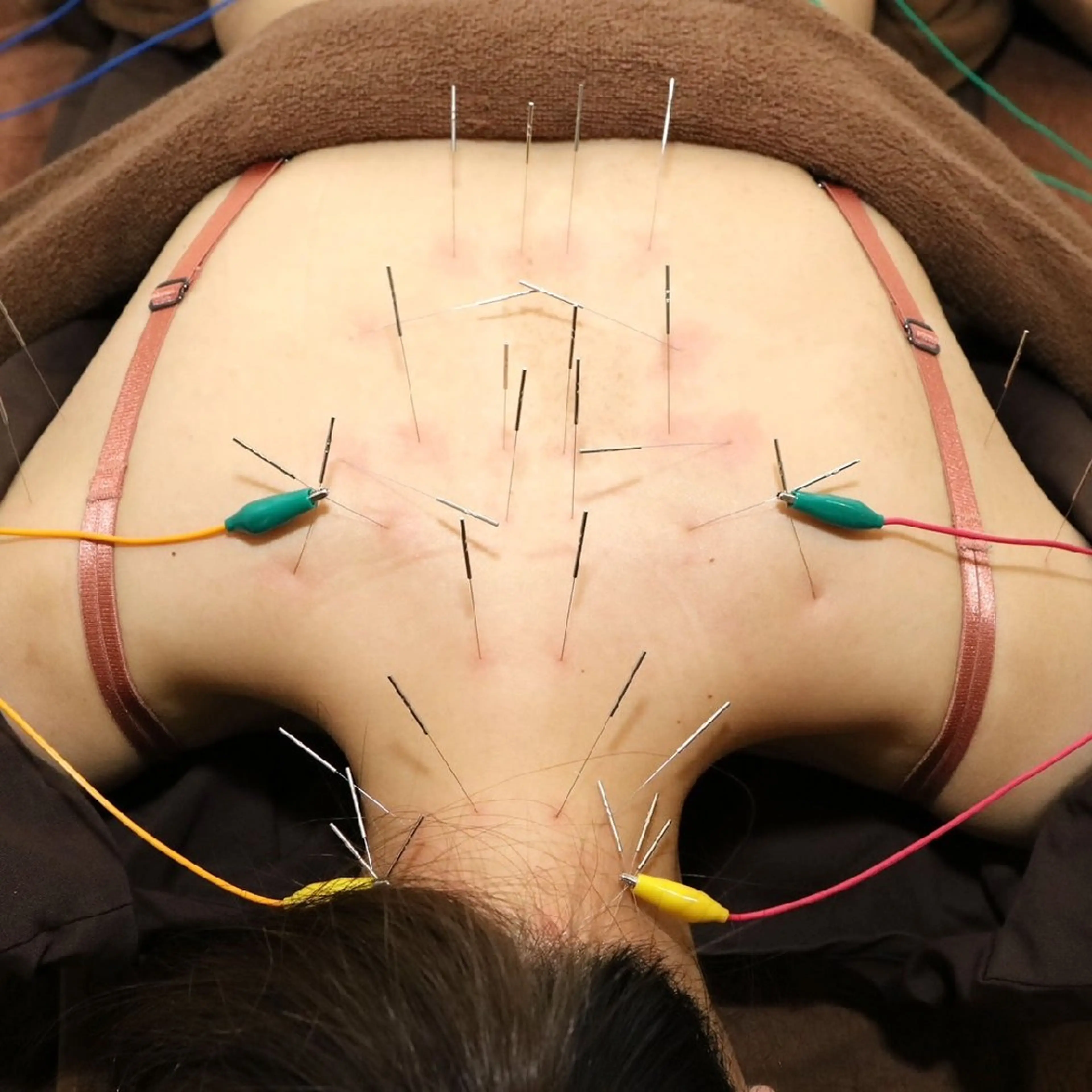 エステ リラク Spring鍼灸院所属・Spring鍼灸院 ✨首肩こり、腰痛に!のエステ・リラクイメージ