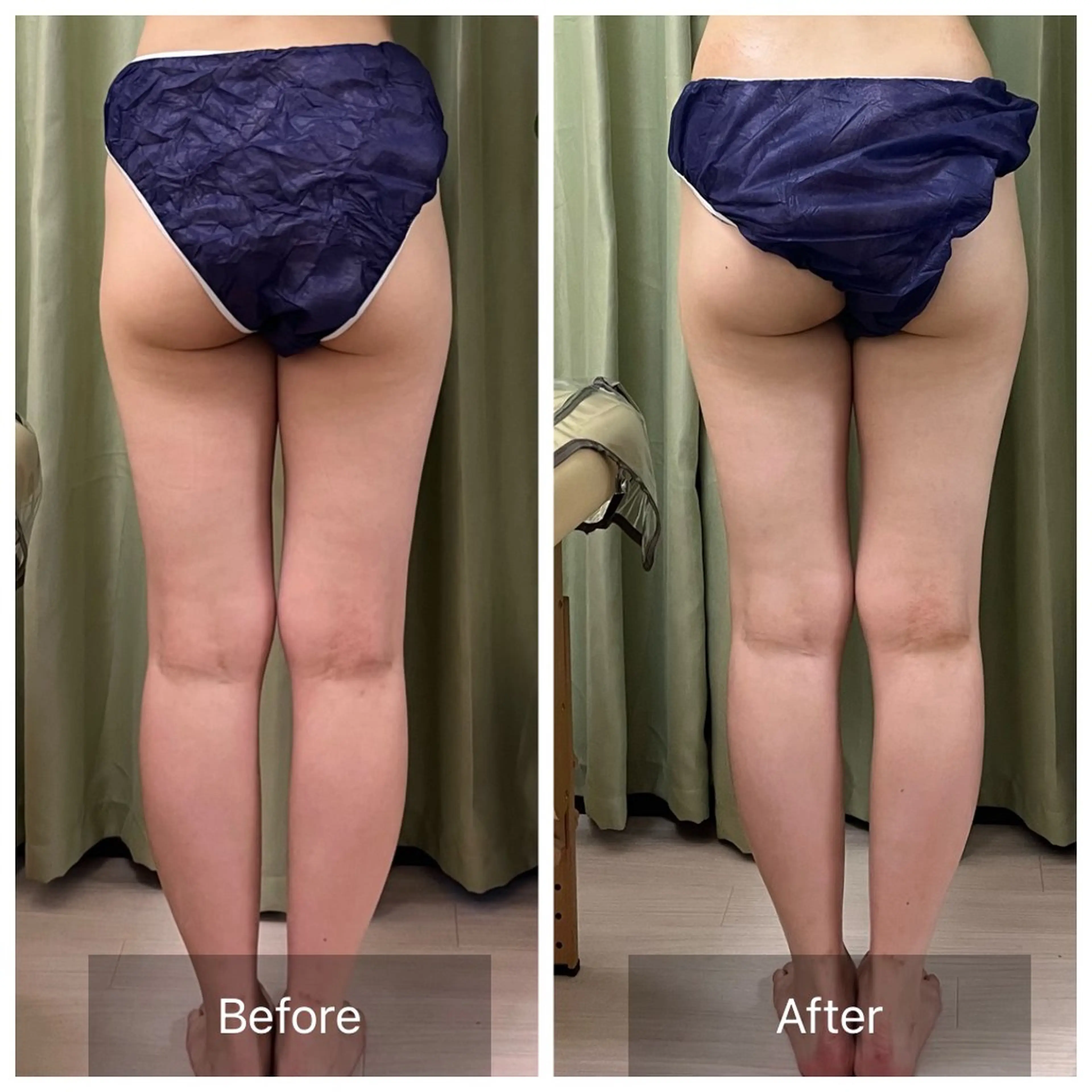 エステ リラク 【元に戻らない】 小顔&部分痩せのその他イメージ