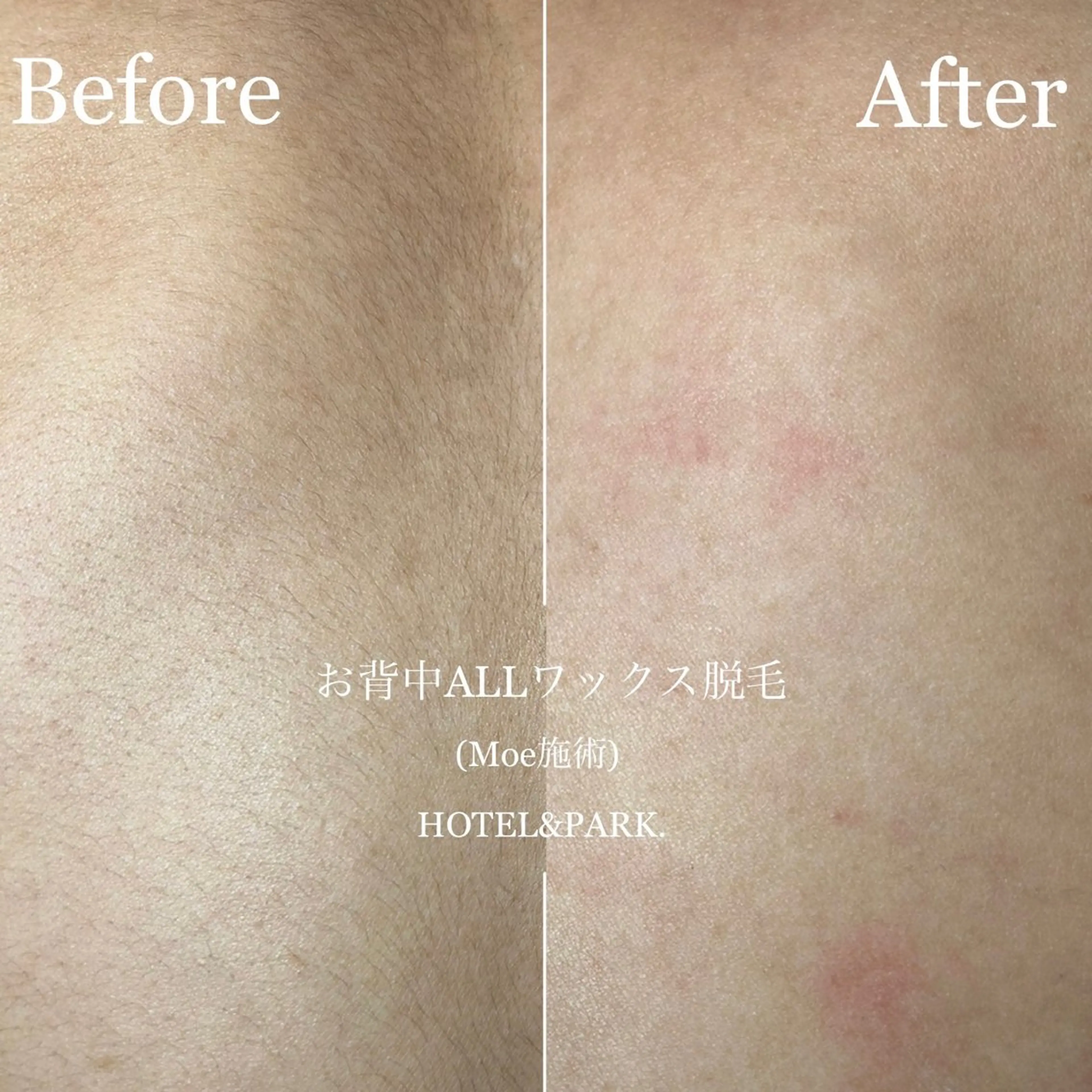 HOTEL&PARK .Moeワックス脱毛のエステ・リラクイメージ