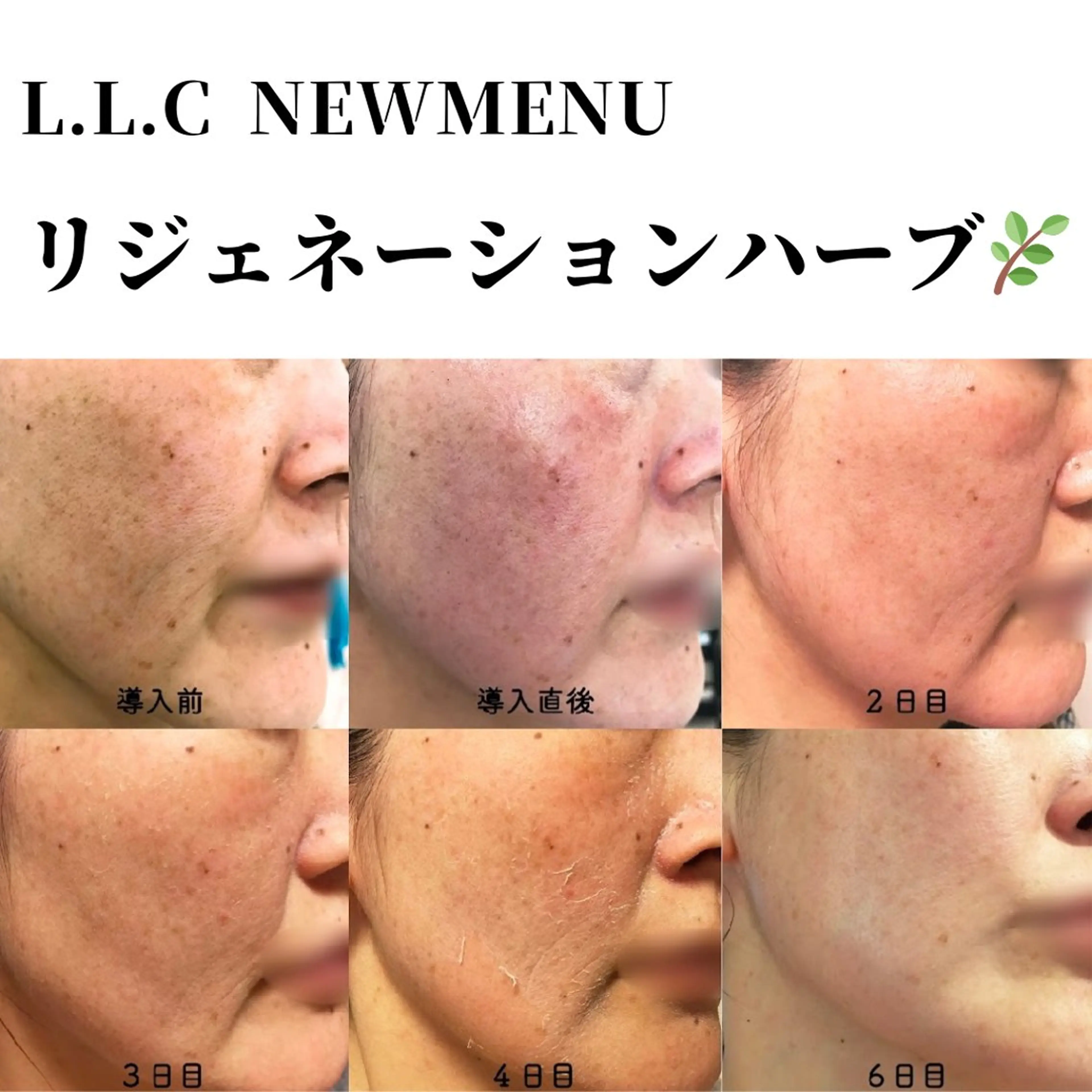 リジェネーションハーブ🌿モニター募集の写真