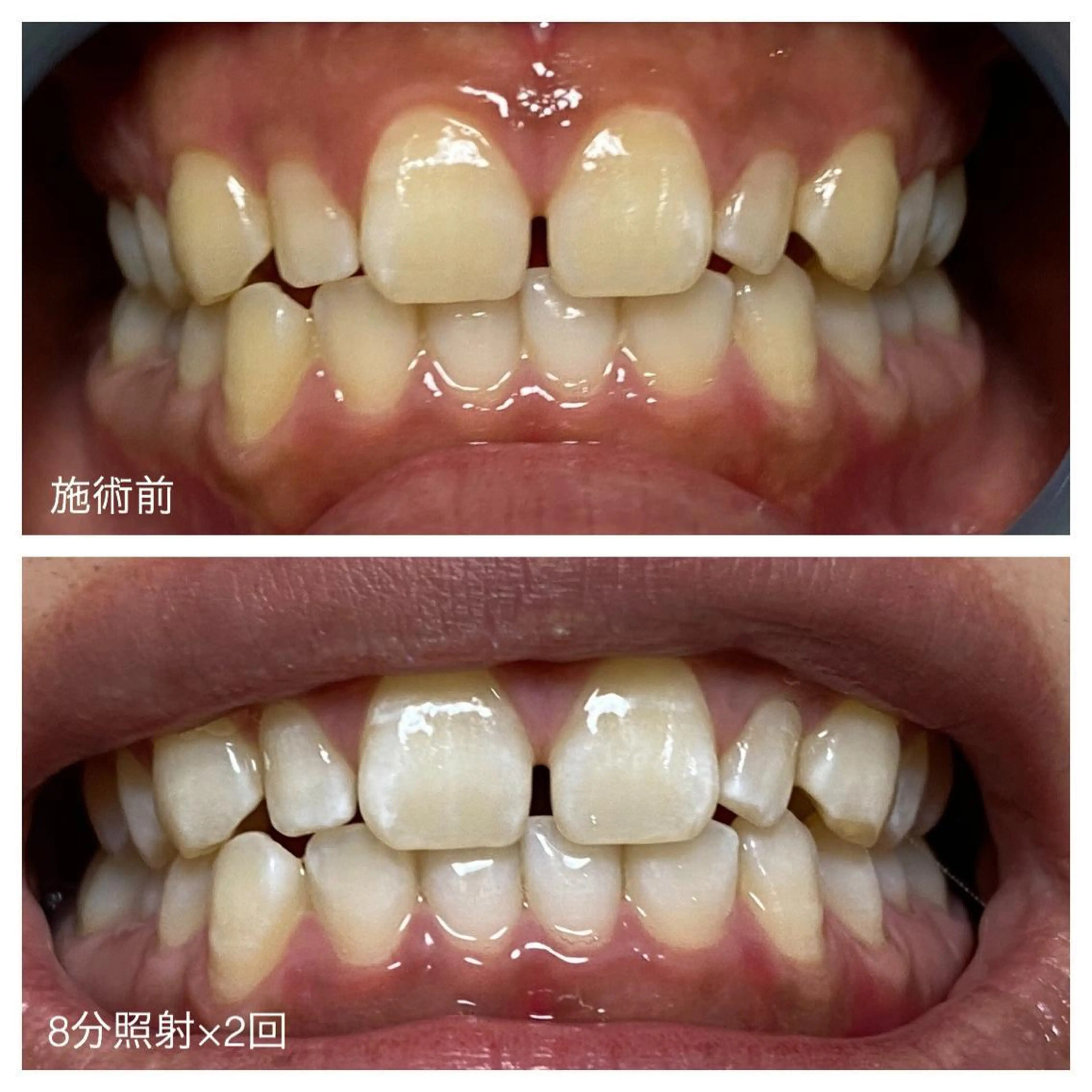 ネイル/耳つぼ /新ホワイトニングのネイルデザイン