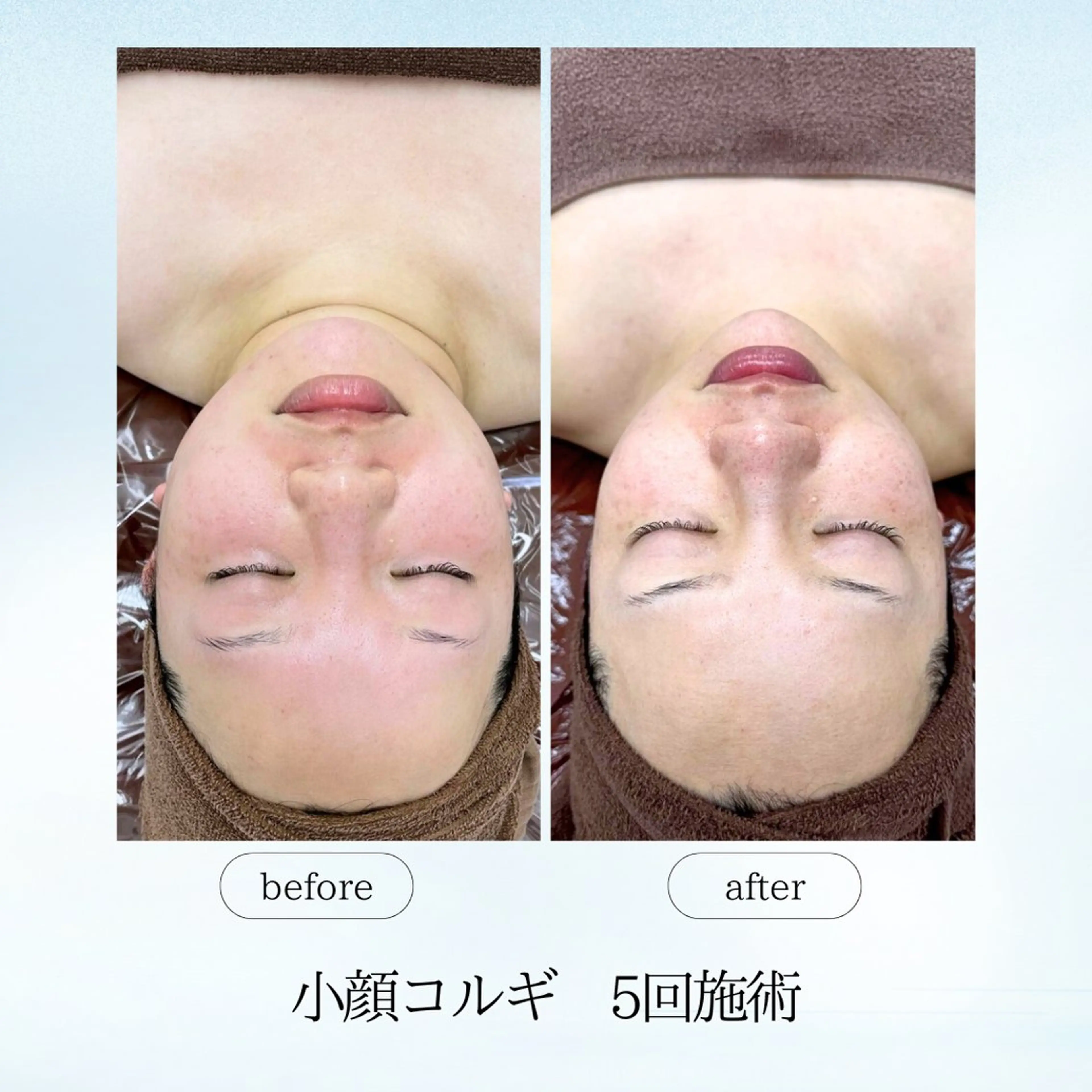 【他サロンにはない珍しいオリジナル】大人気整形級の小顔コルギ！オールハンドで腕、背中、首、顔、頭までしっかりほぐします✨の写真