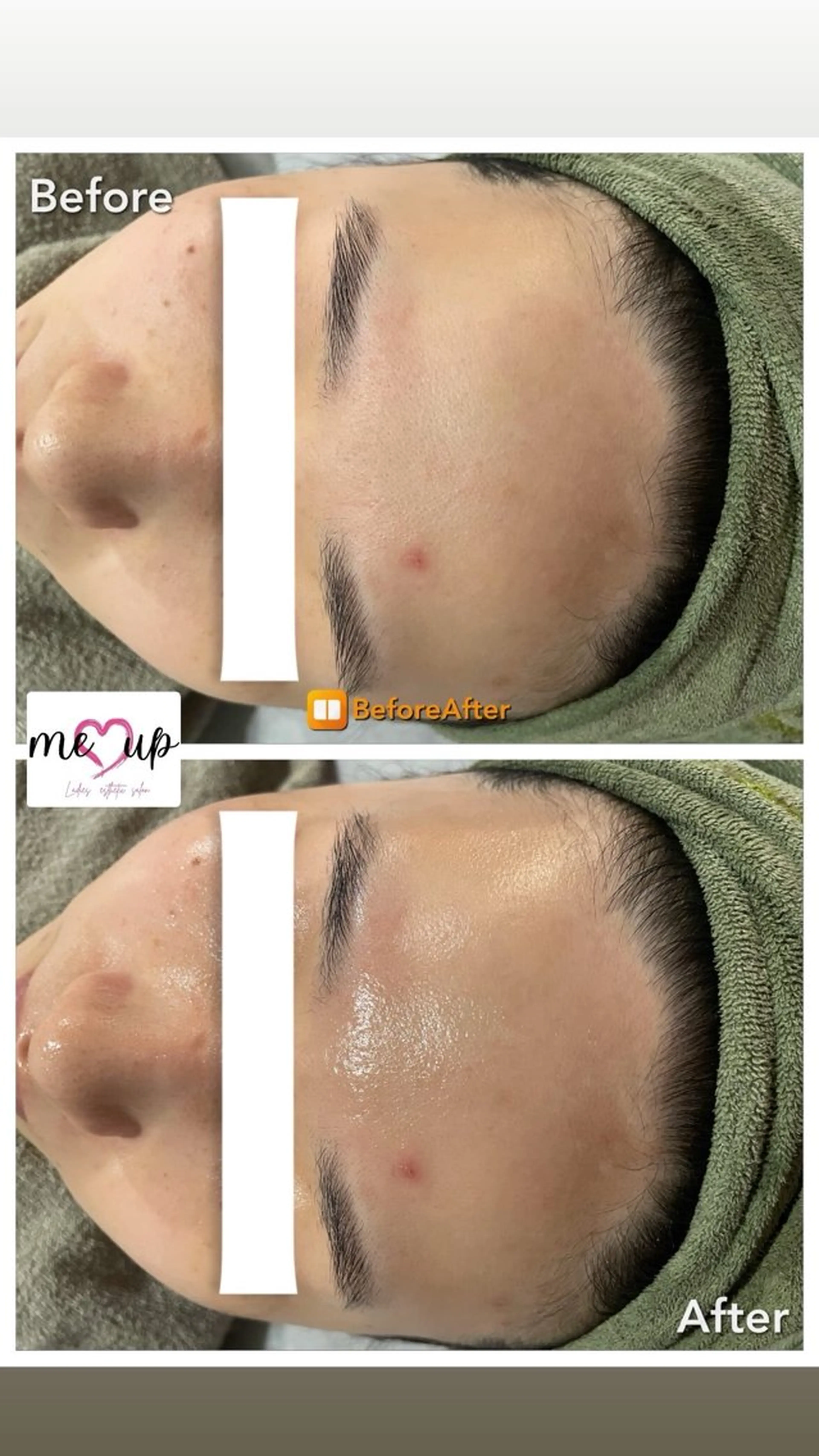 エステ Meupニキビ専門店 背中/ハーブ/肌管理のその他イメージ