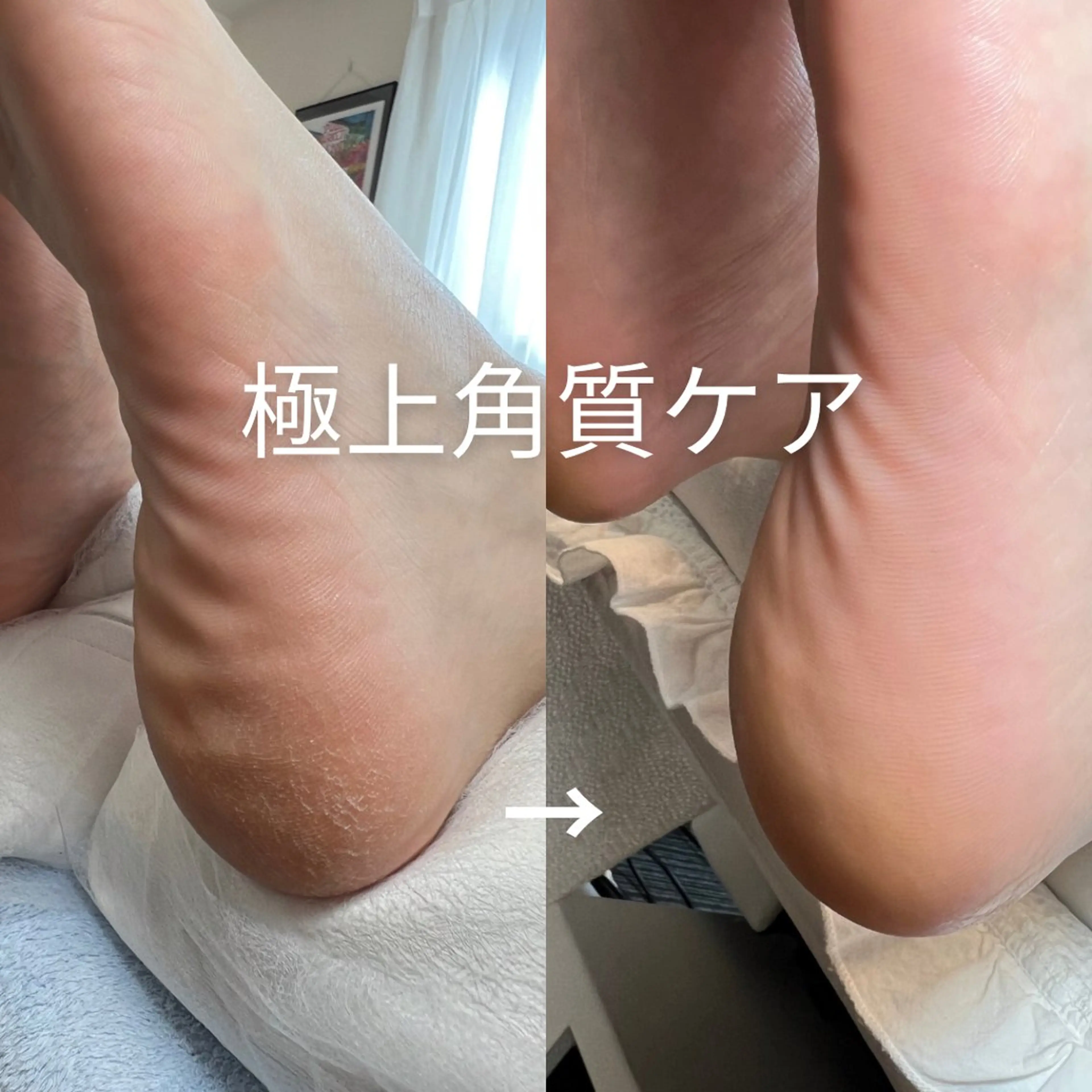 【ご新規様】フットネイルオフ＋極上角質ケアの写真