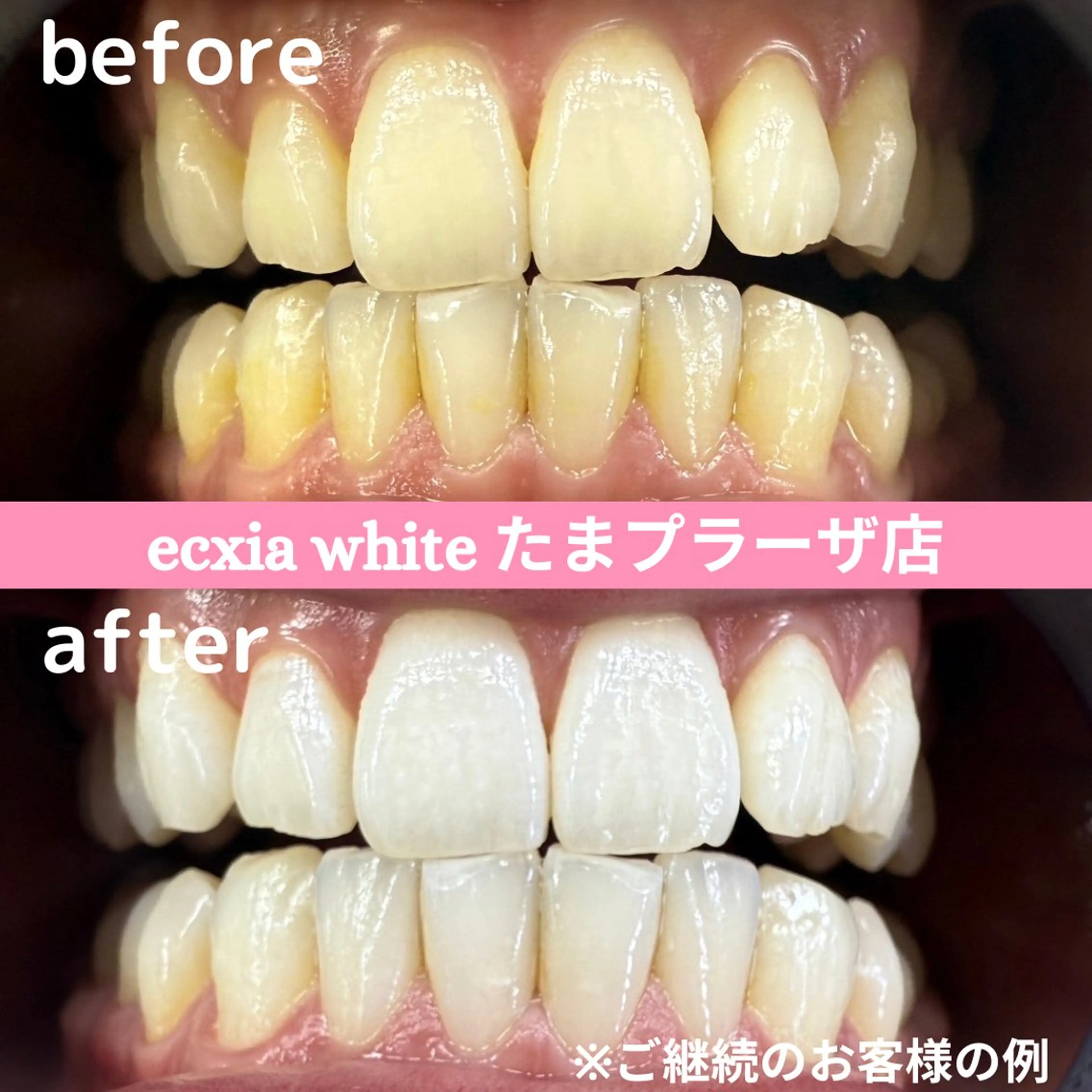 1回で白さ実感♪強力セルフホワイトニング45分初回体験 ¥9980→¥2980の写真