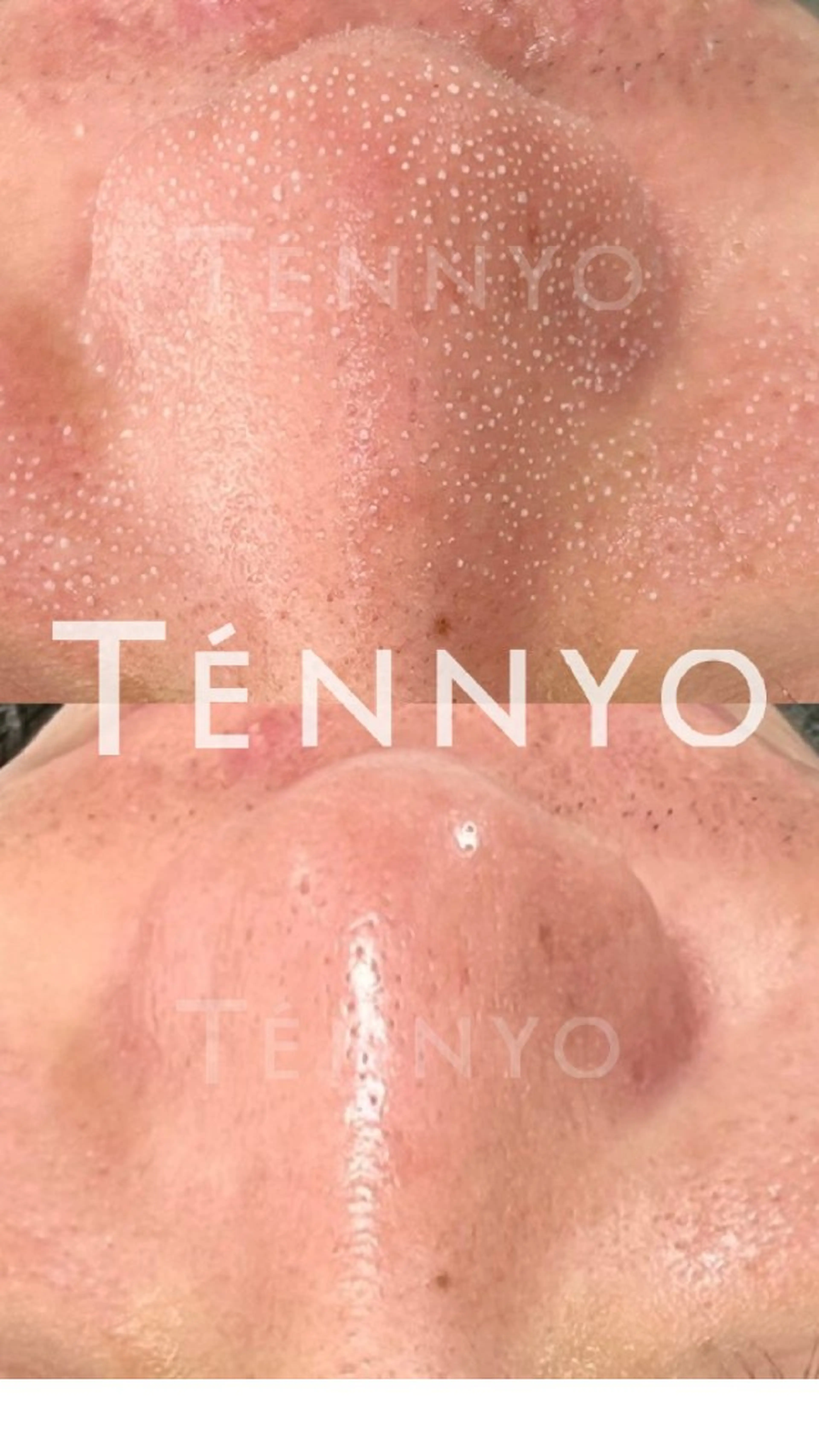 エステ リラク 毛穴ケア くすみ肌 ハーブピーリングのエステ・リラクイメージ