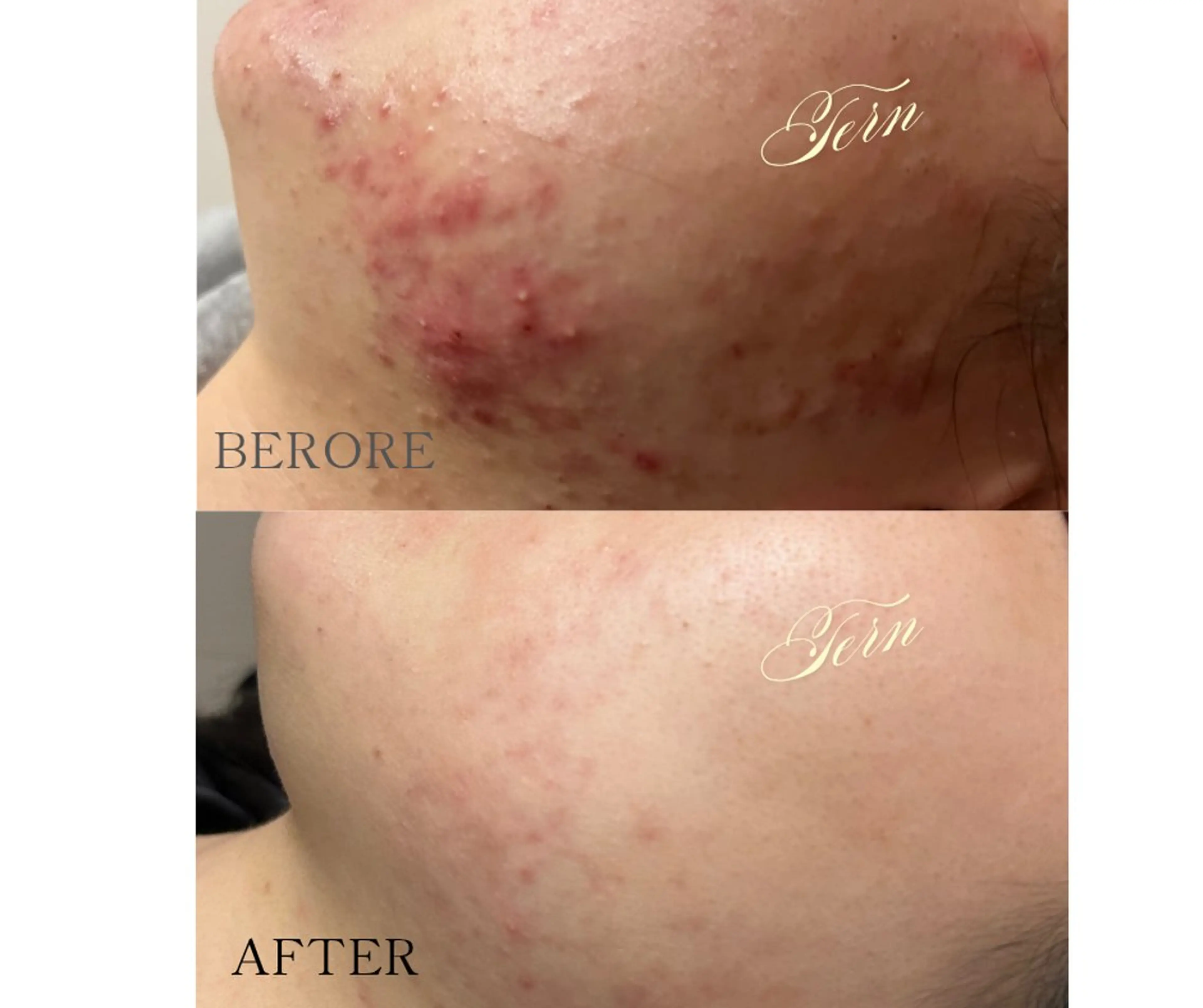 プラズマニキビケアコース☆お試し価格の写真