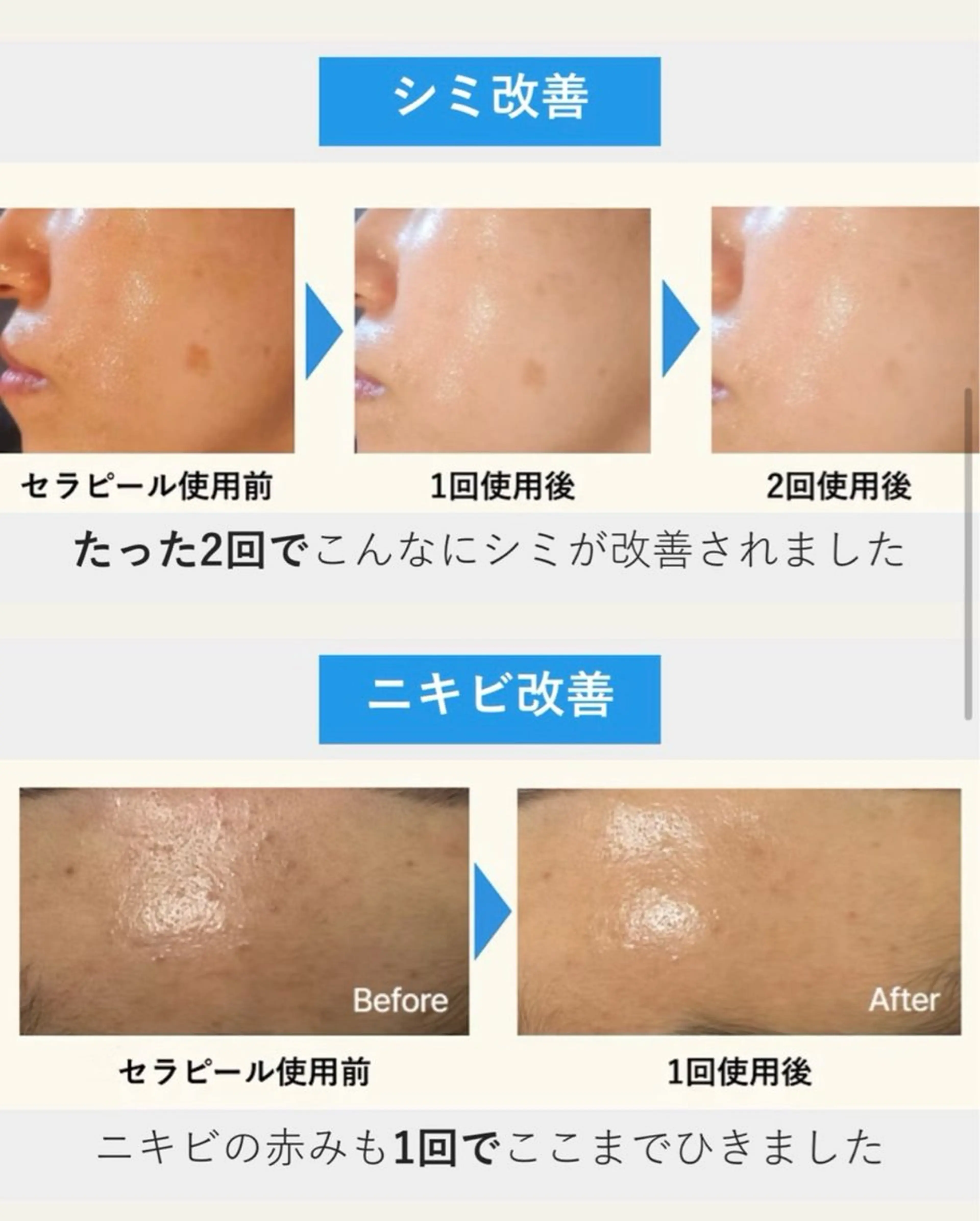 肌を育てるピーリング『セラピール』の写真