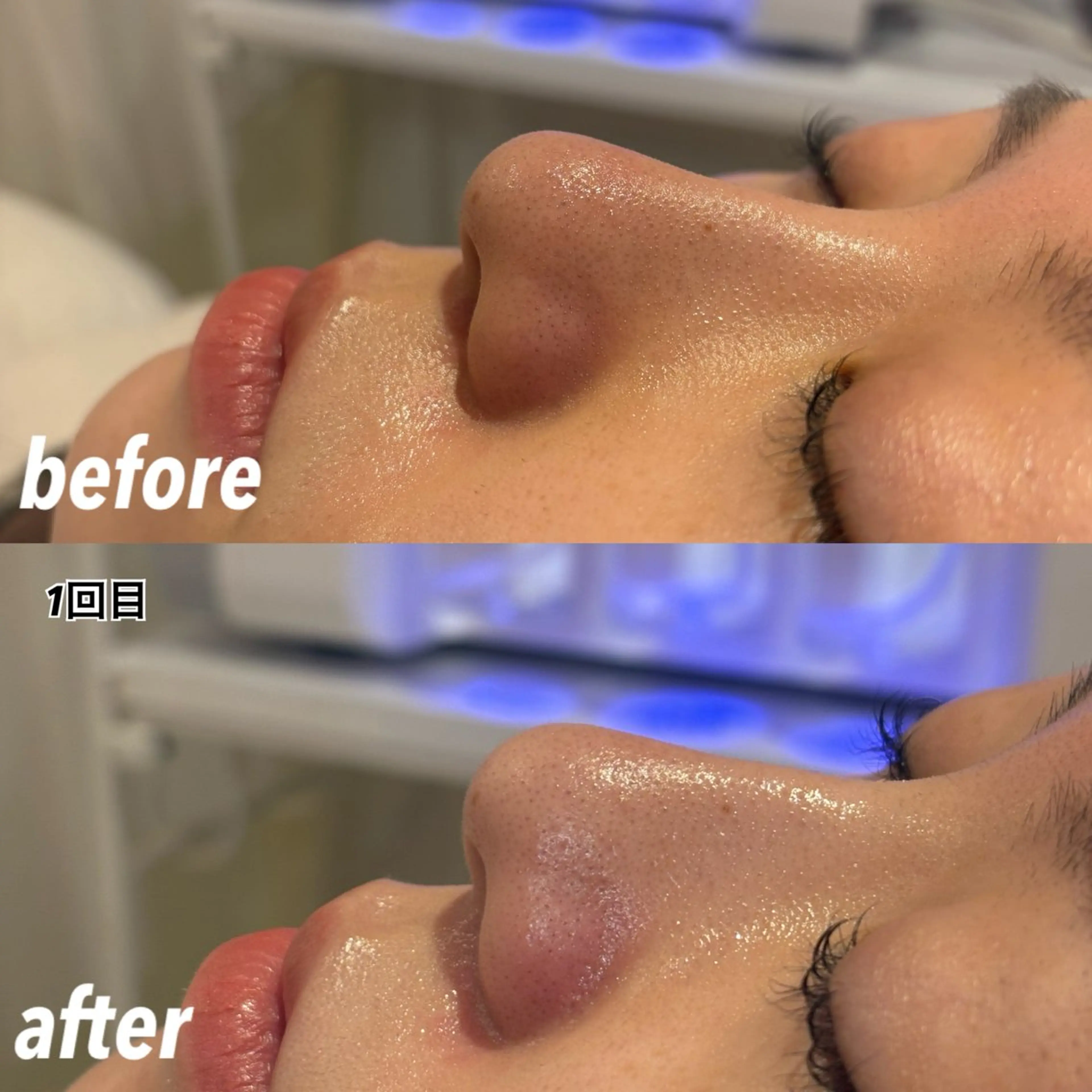 🫧ハイドラフェイシャル モニター様限定🫧（(年末のご褒美スキンケア🎍✨))の写真