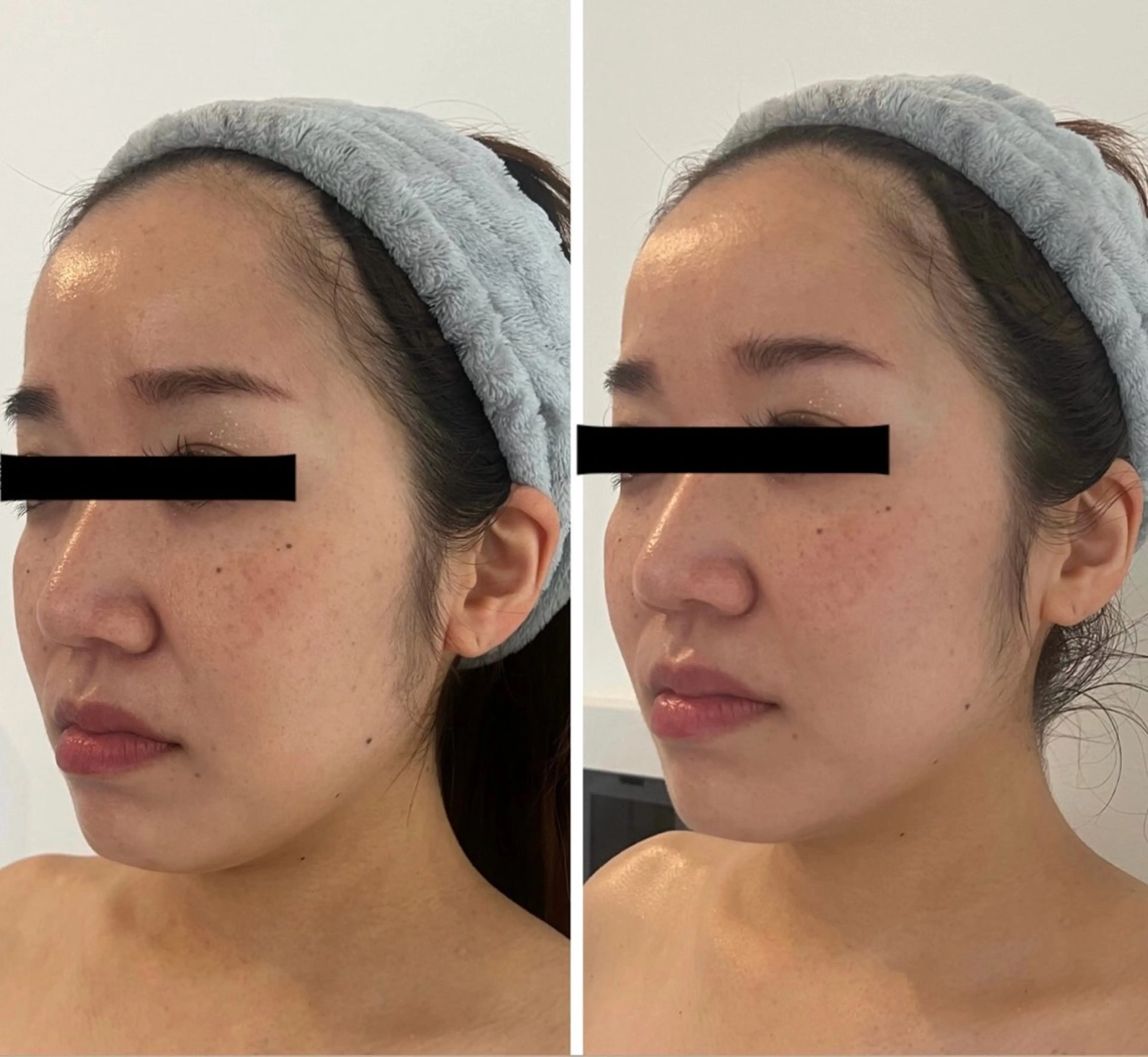 M.plus所属・水光韓国肌ハーブ ピーリングMplusのエステ・リラクイメージ