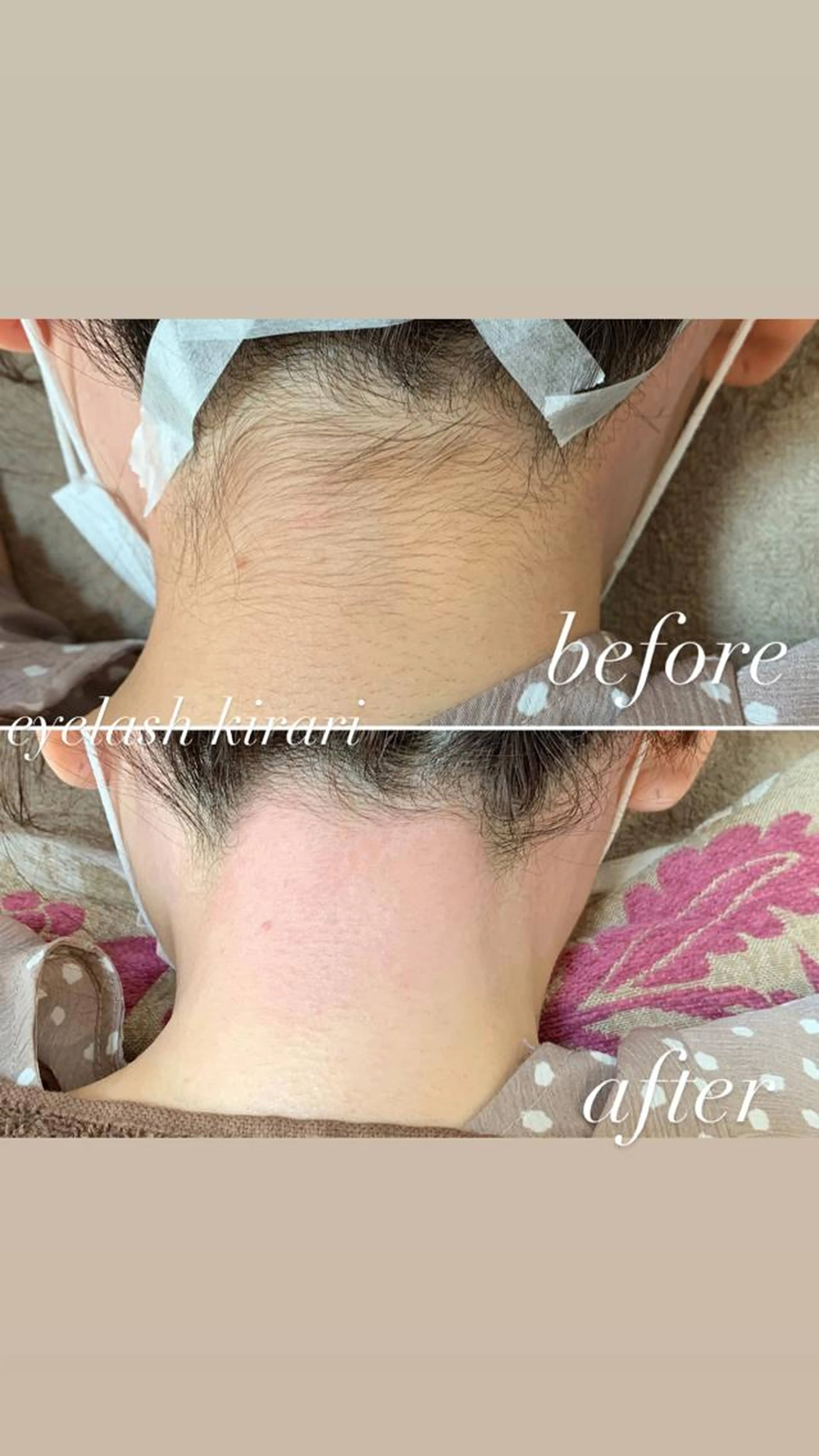 アップスタイルで後ろ姿美人♡うなじwax脱毛👳‍♀️✨の写真