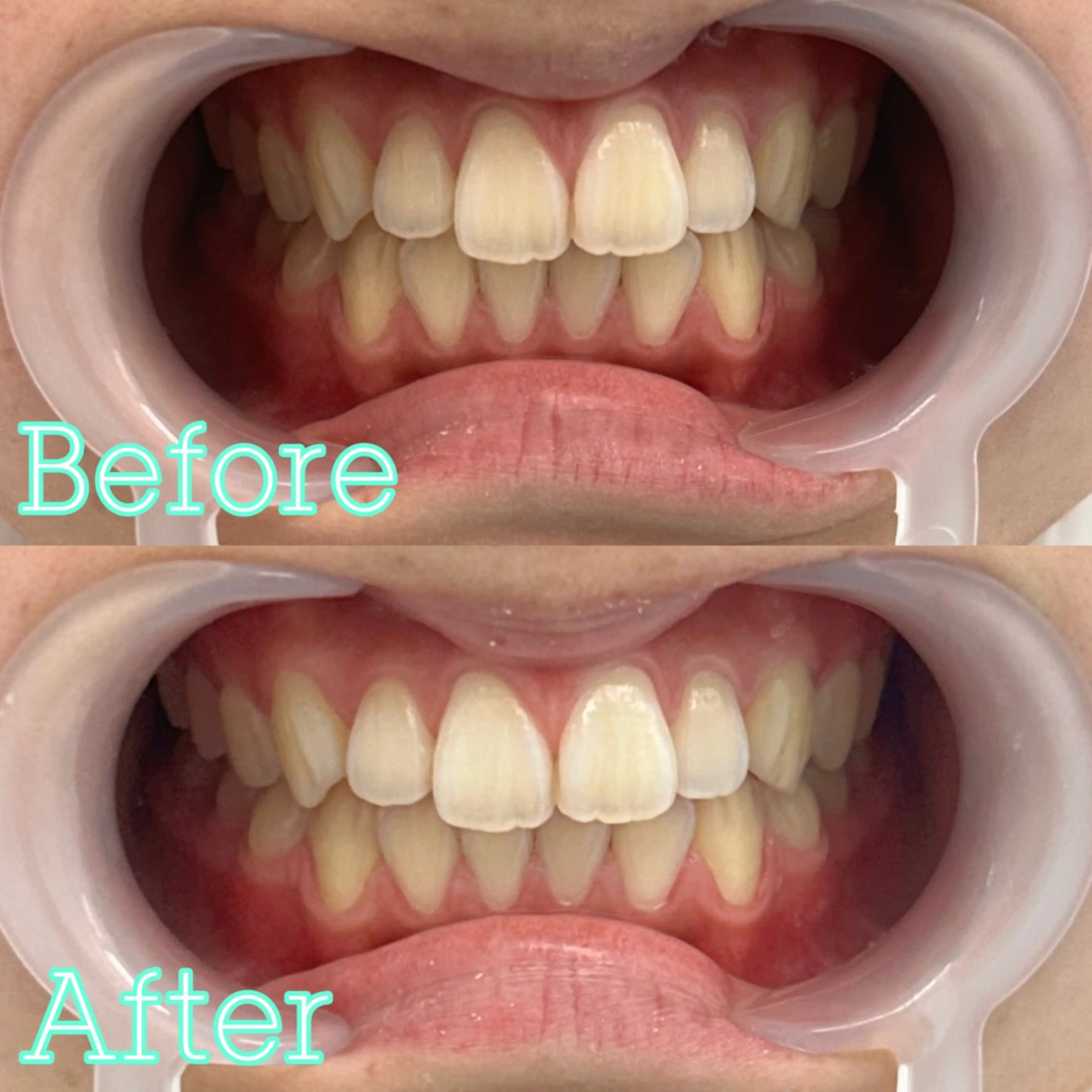 【サブスク会員】🌱通い放題セルフホワイトニング🌱の写真