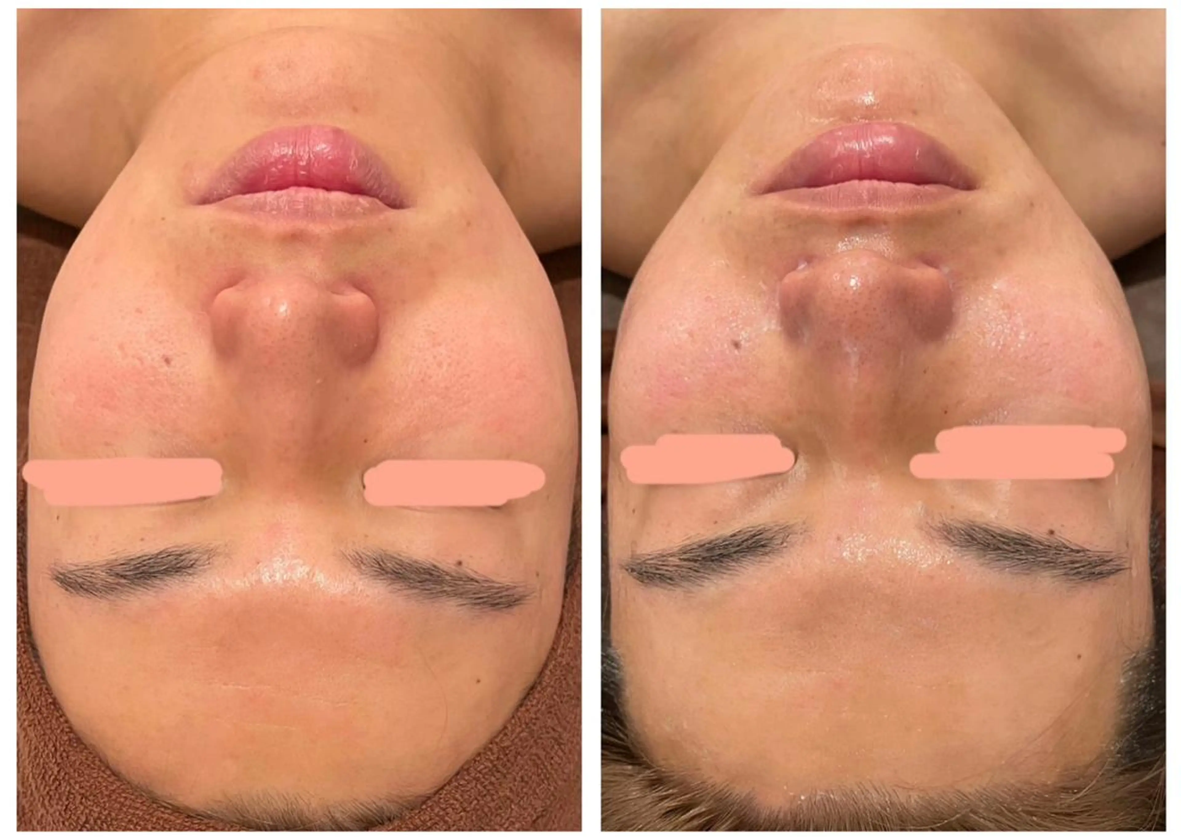 メンズ エステ Meow！～トラブル肌専門ピーリング＆脱毛サロン～所属・トラブル肌改善🏥 Meow！🫧🫧のその他イメージ