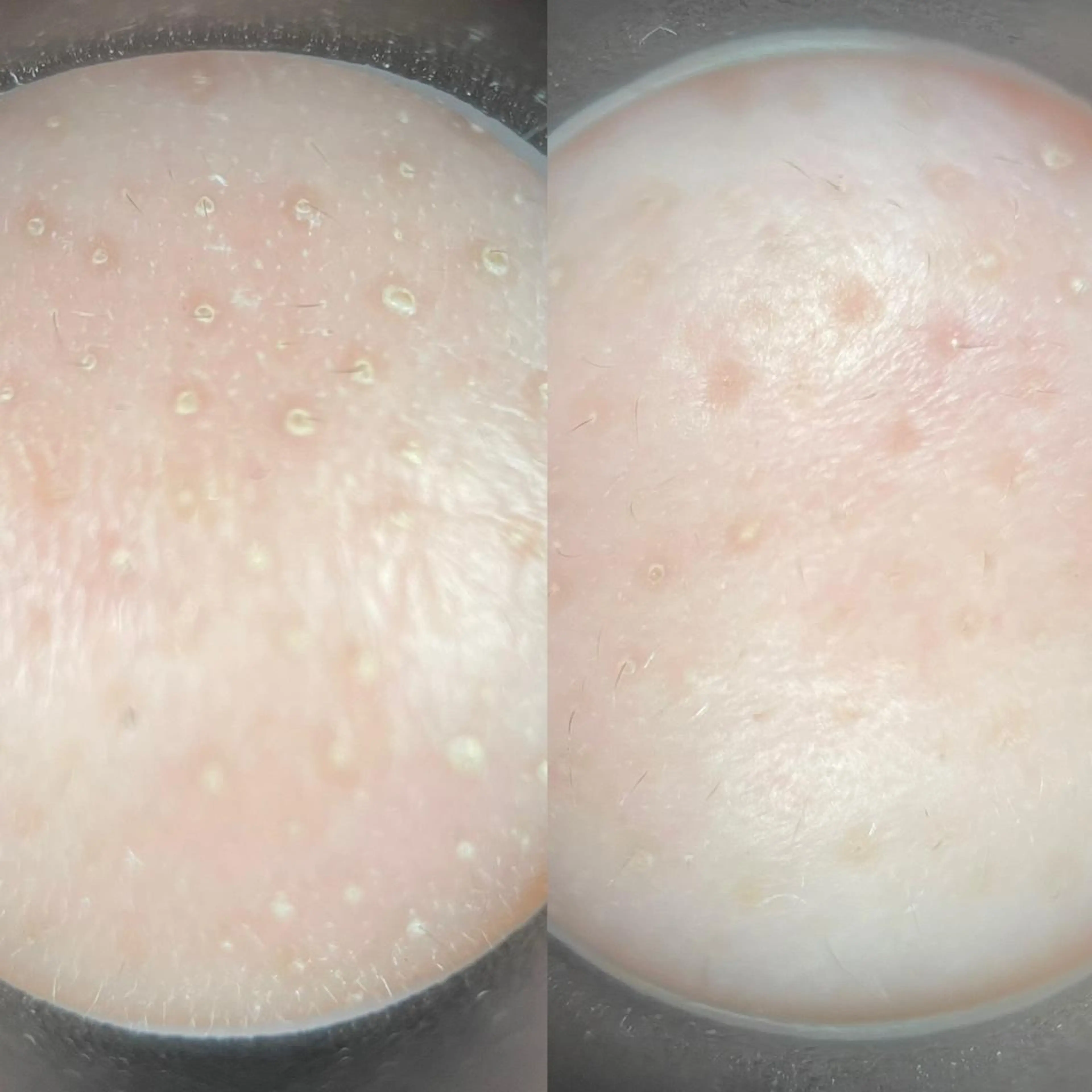 大人気!毛穴汚れさようなら!滑らか肌作りエステの写真