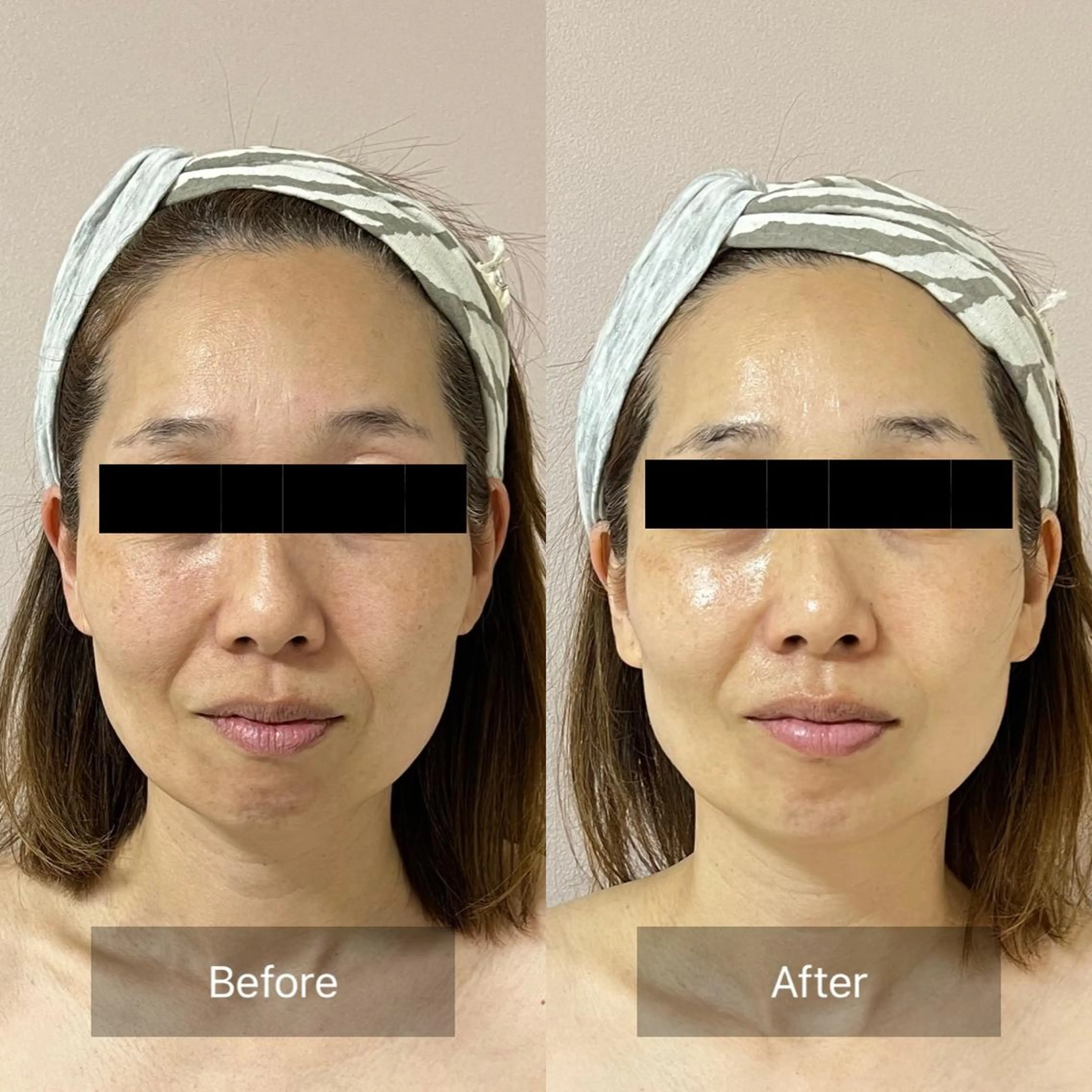 本気の小顔×毛穴ケア ／もりやま はるかのエステ・リラクイメージ