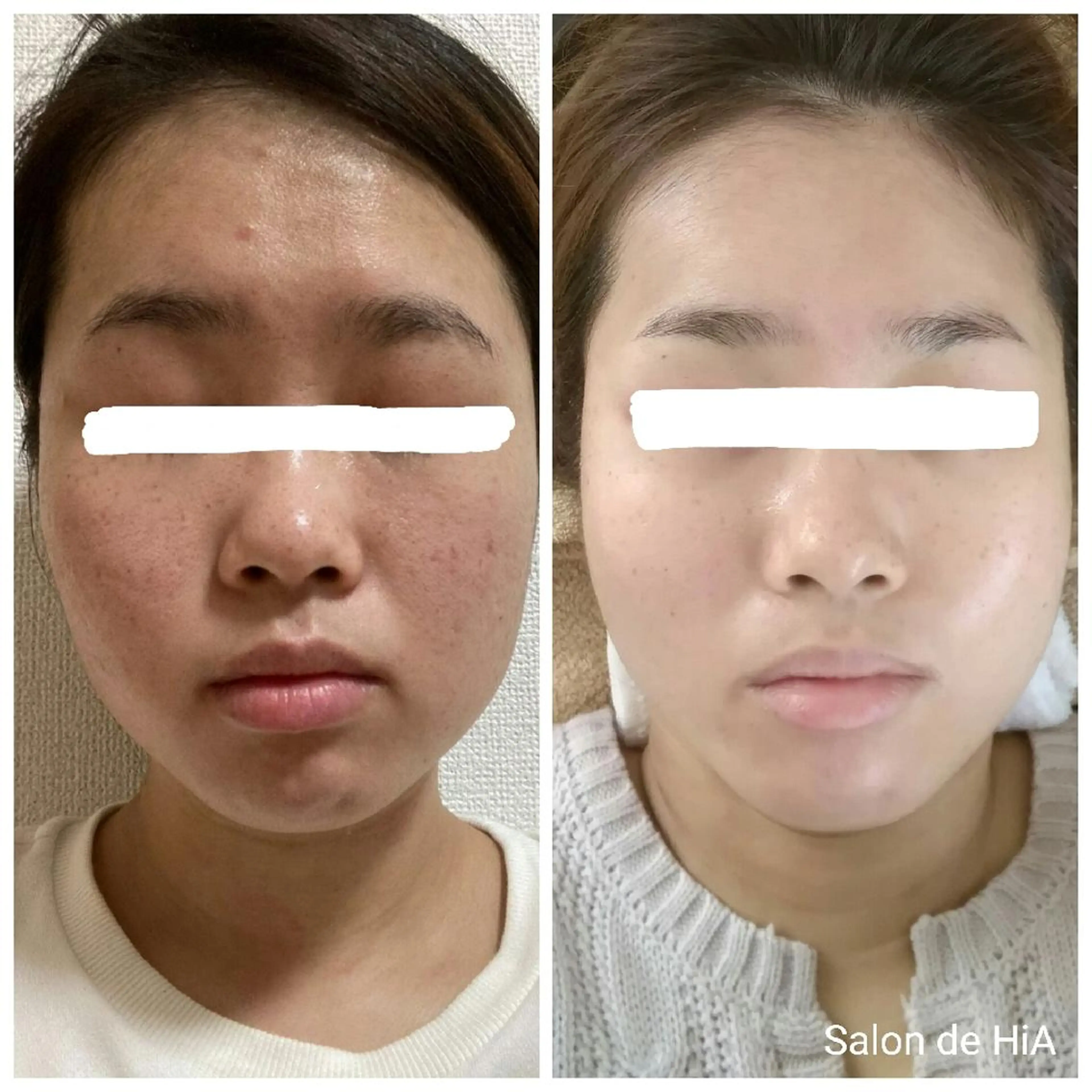 60分🕑️肌質改善🌿日本製ハーブピーリング🌿剥離なし◎ダウンタイムなし◎痛みなし◎即メイクOK◎の写真